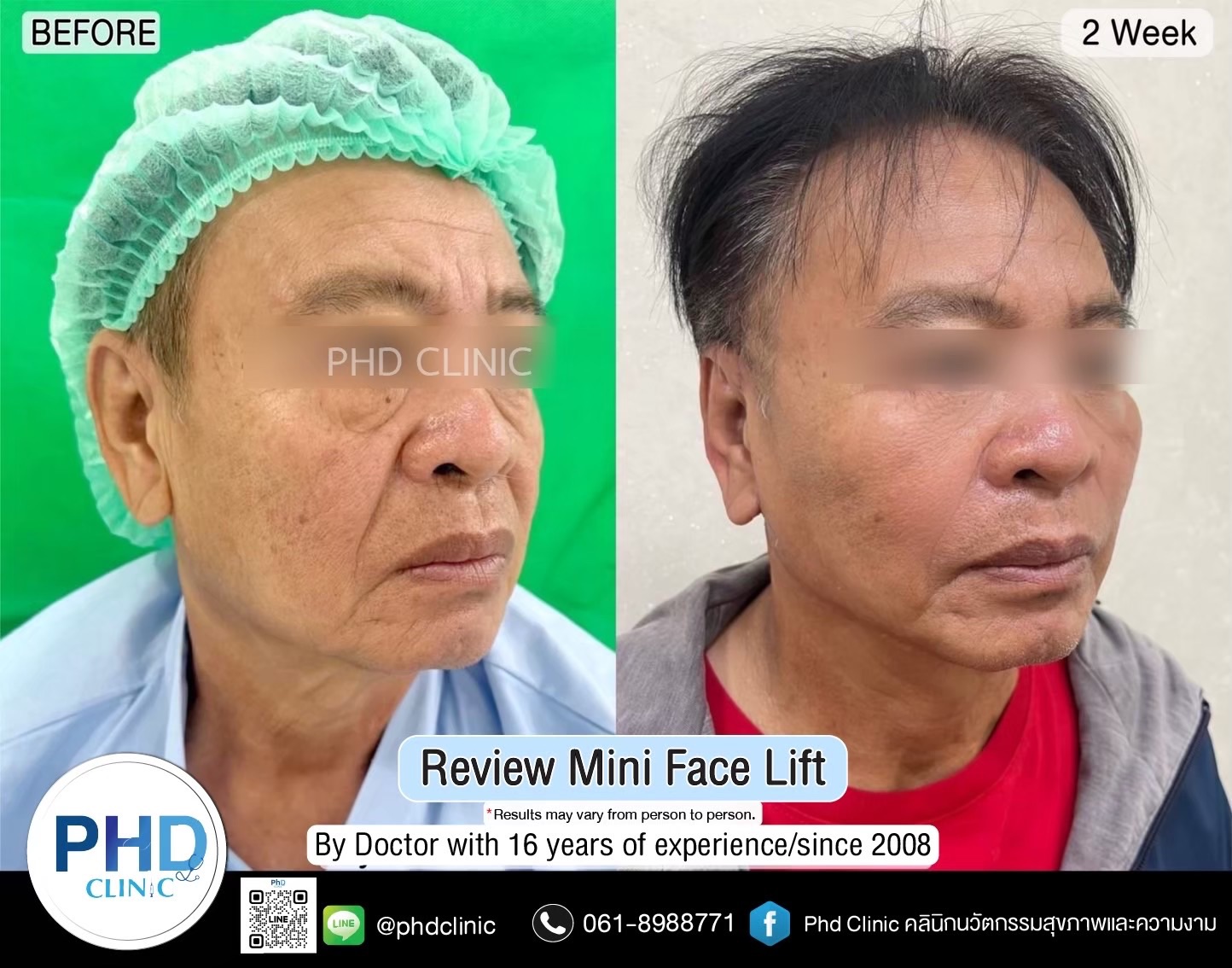 review Facelift Surgery Phuket 2026