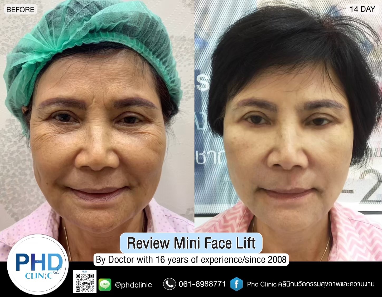 review Facelift Surgery Phuket