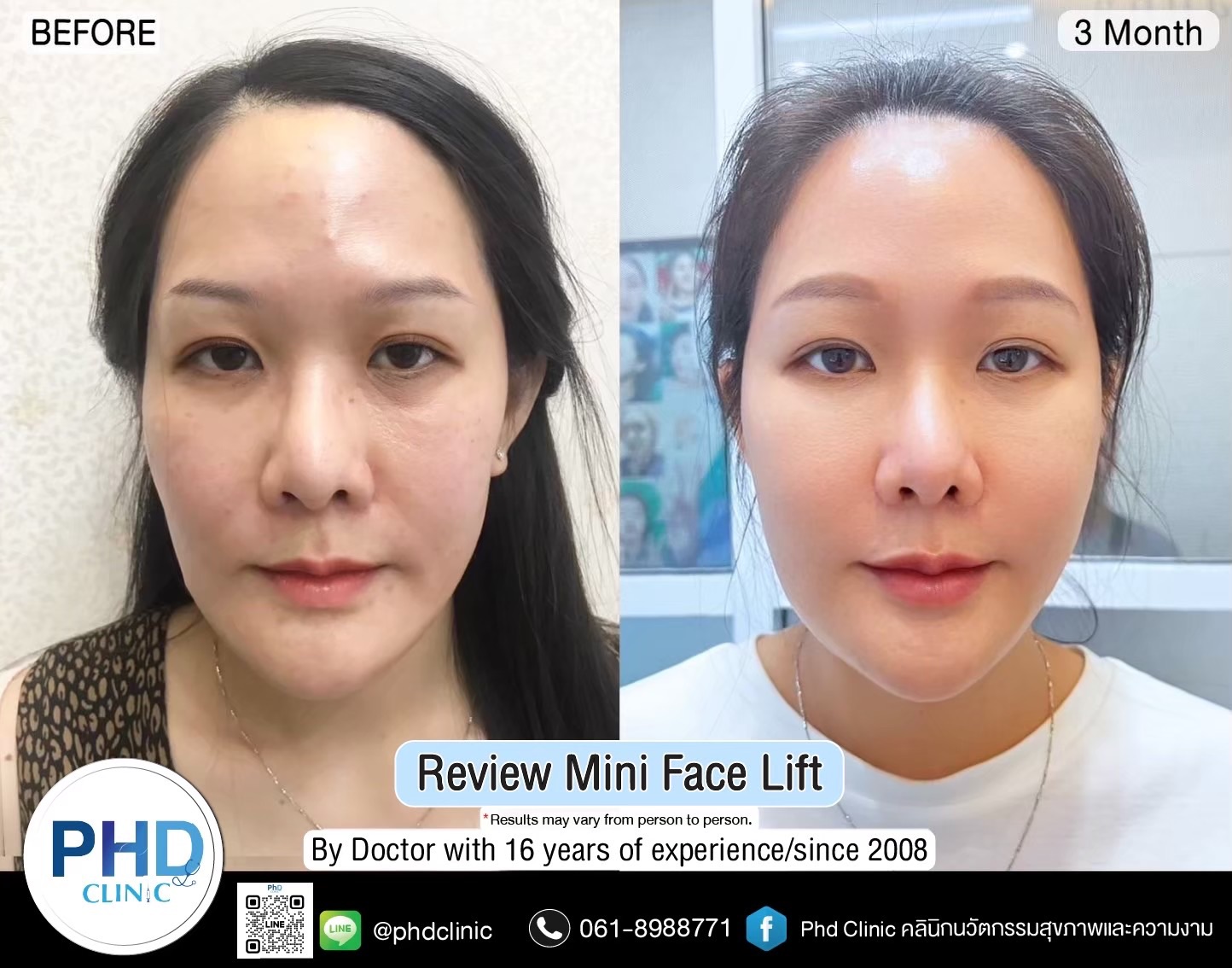 review Facelift Surgery Phuket