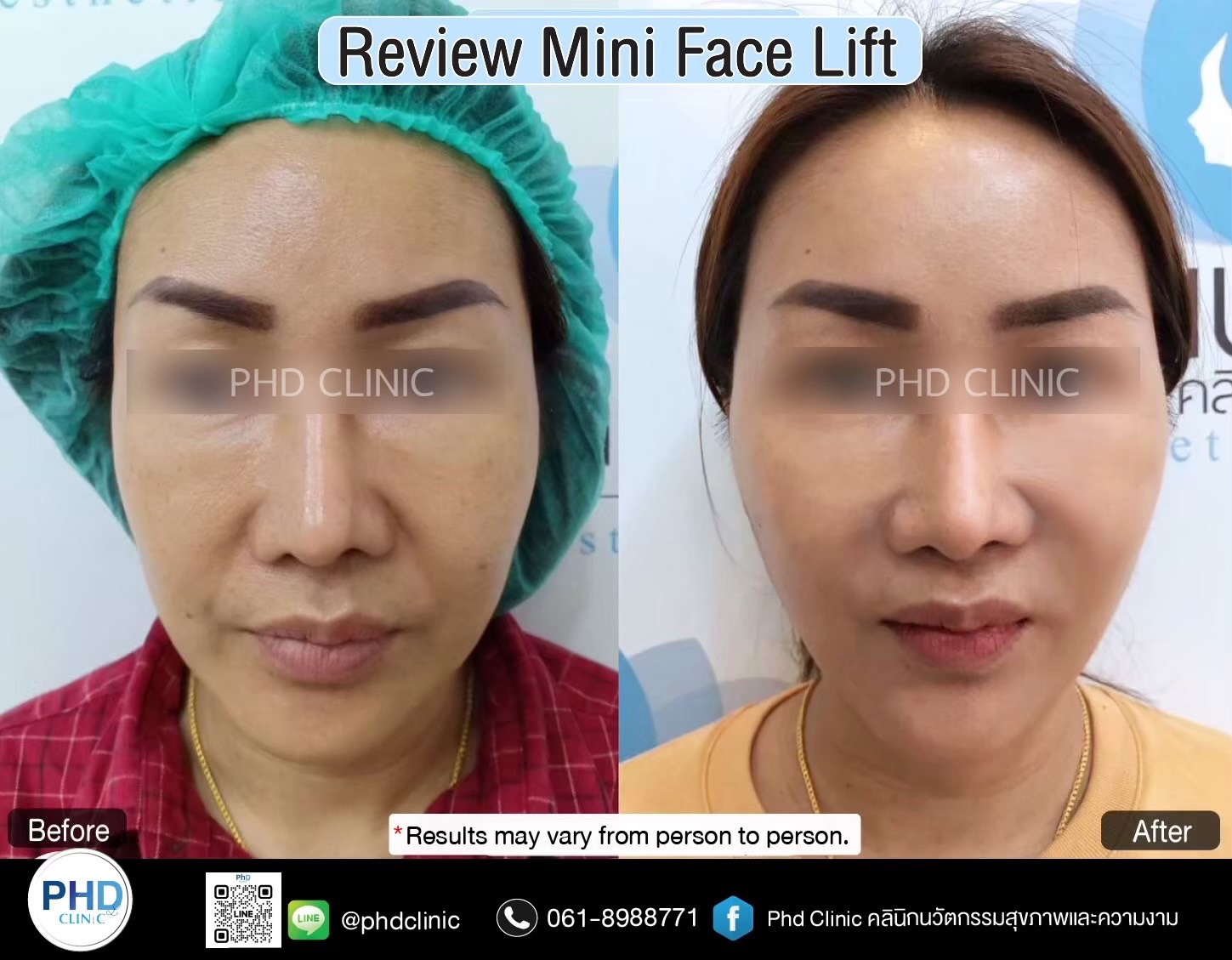 review Facelift Surgery Phuket