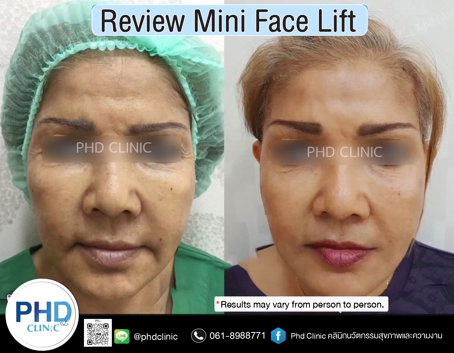 review Facelift Surgery Phuket