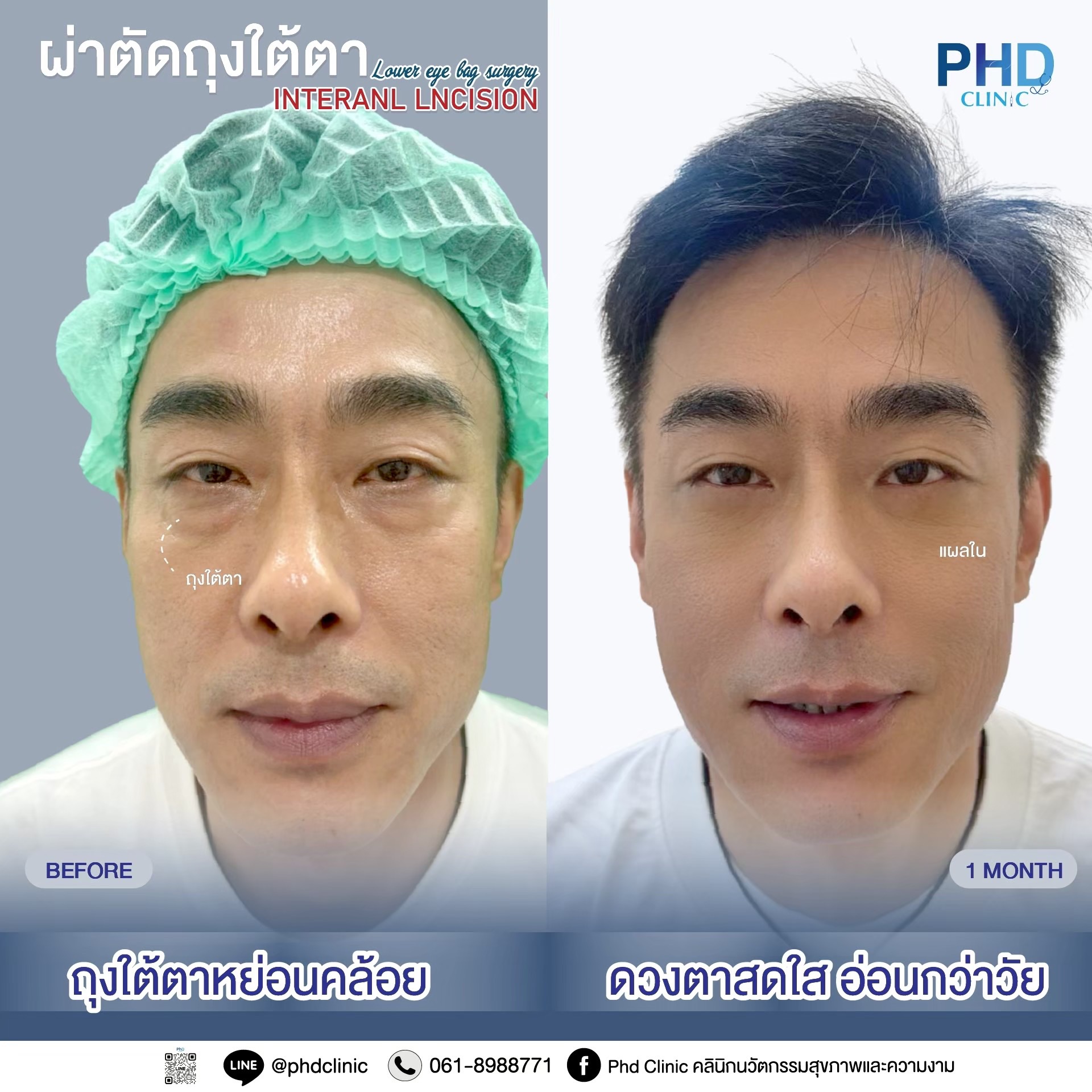 ผ่าตัดถุงใต้ตาพัทยา