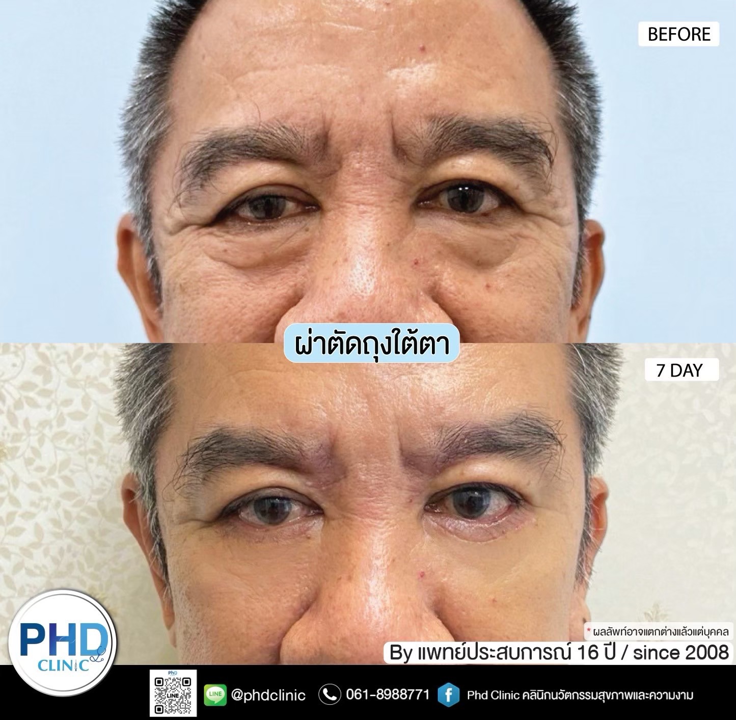 ผ่าตัดถุงใต้ตาพัทยา