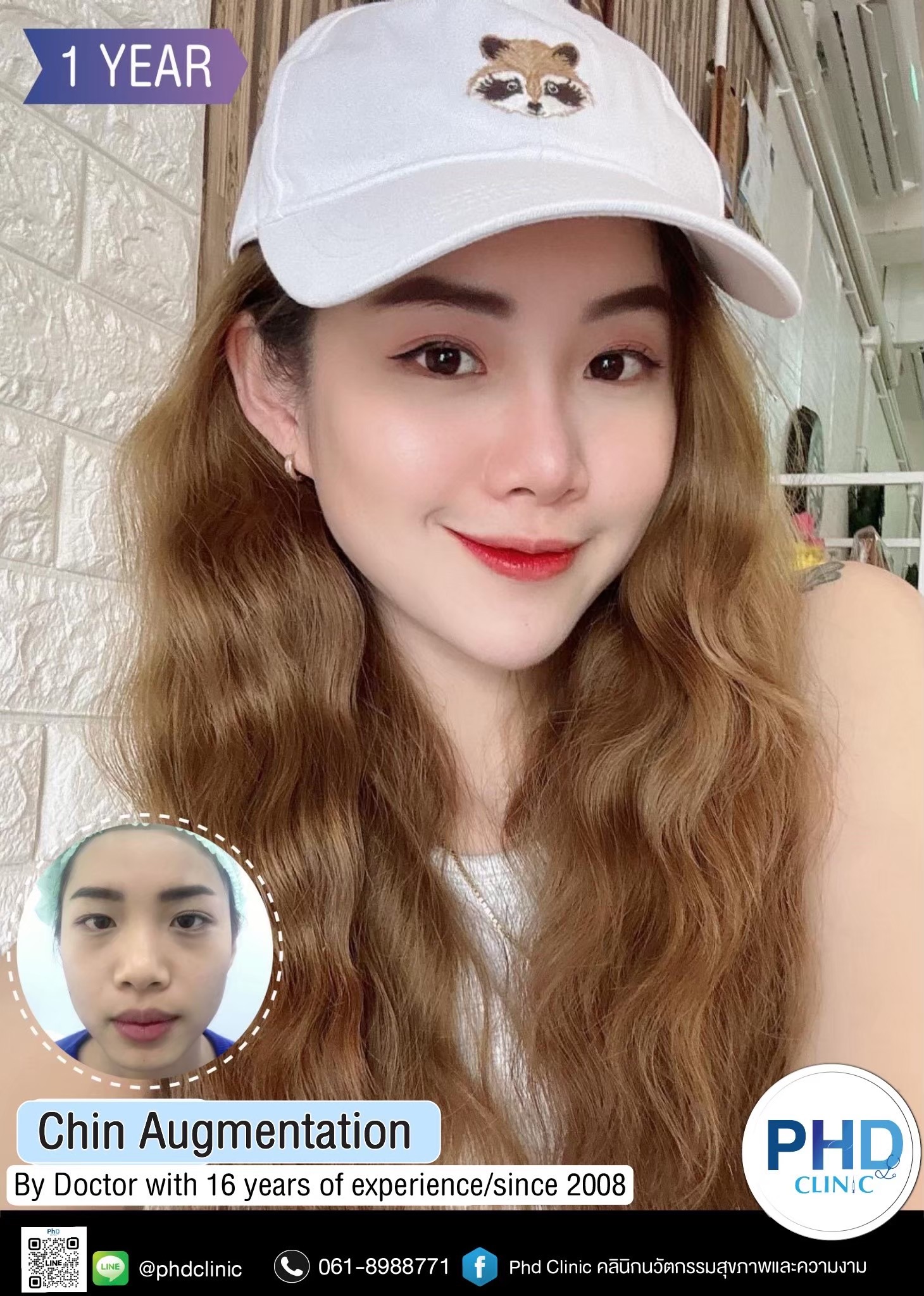 Chin augmentation in Pattaya