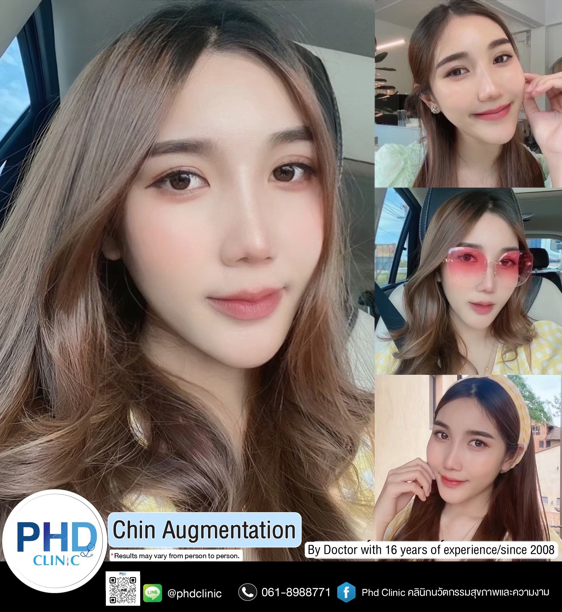 Chin augmentation in Pattaya