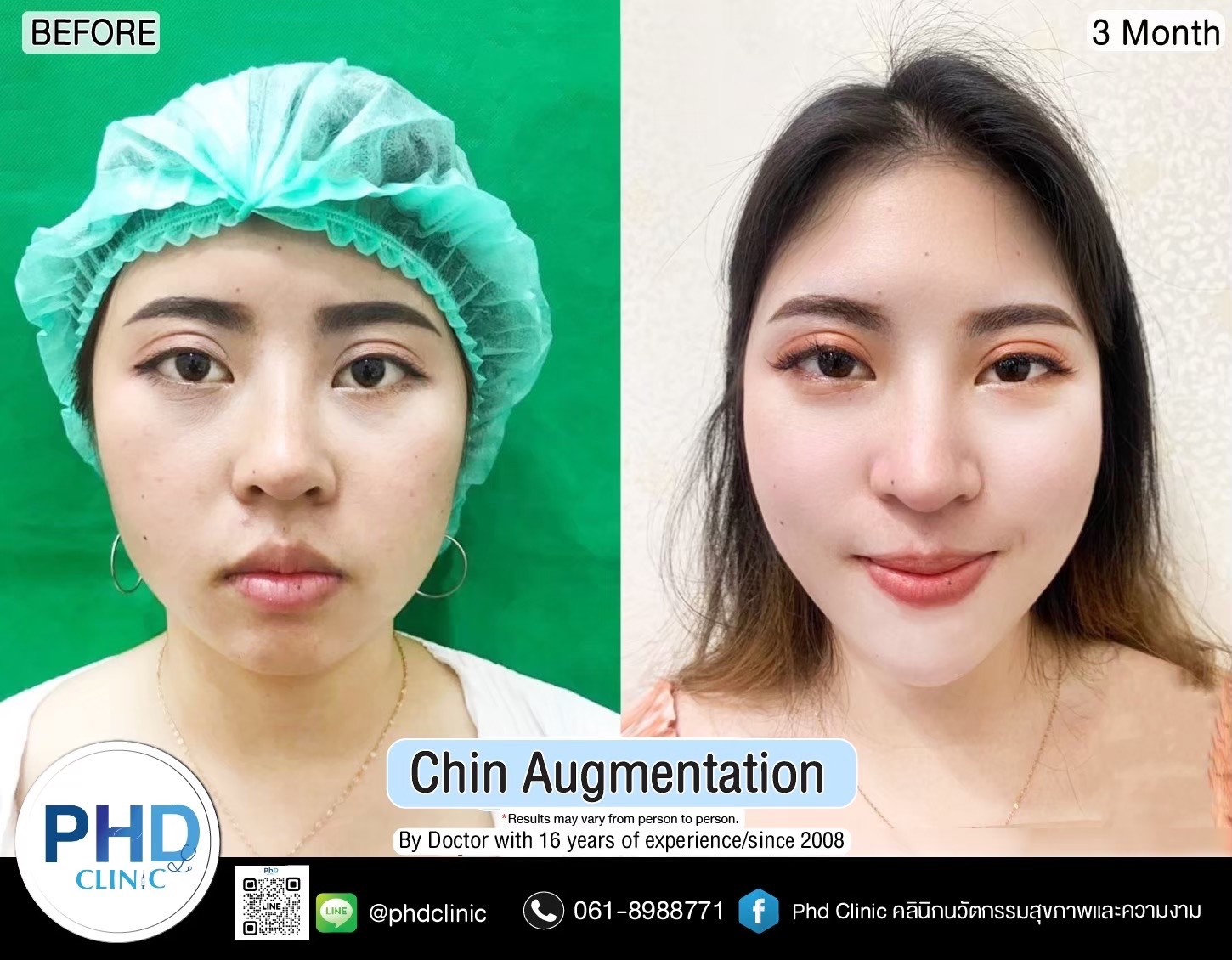 Chin augmentation in Pattaya