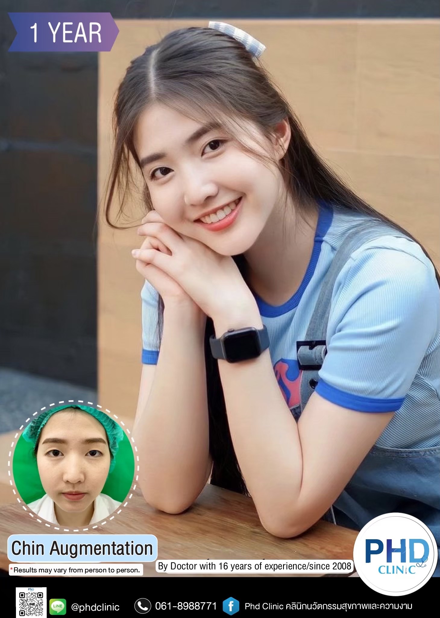 Chin augmentation phuket