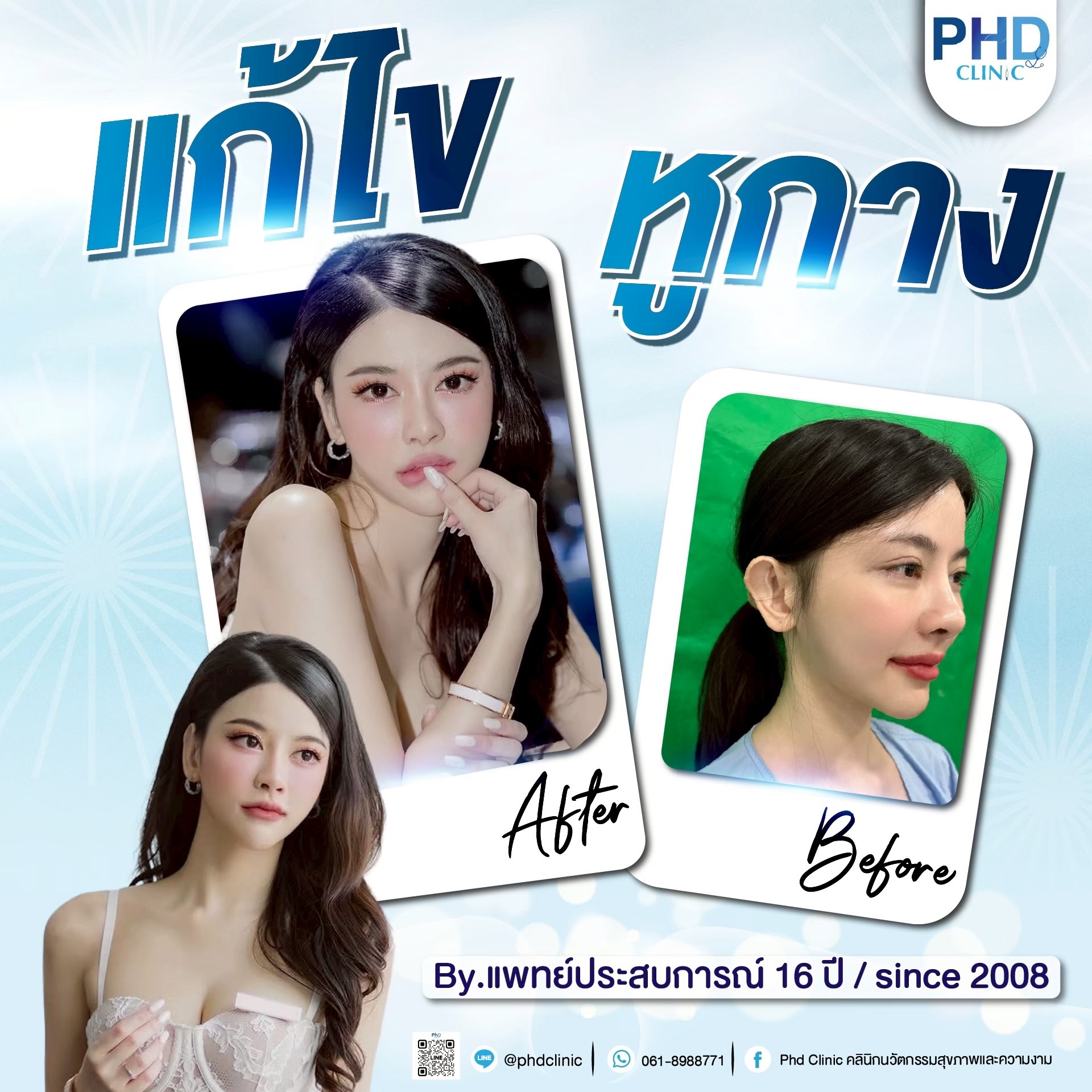 ผ่าตัดแก้หูกาง