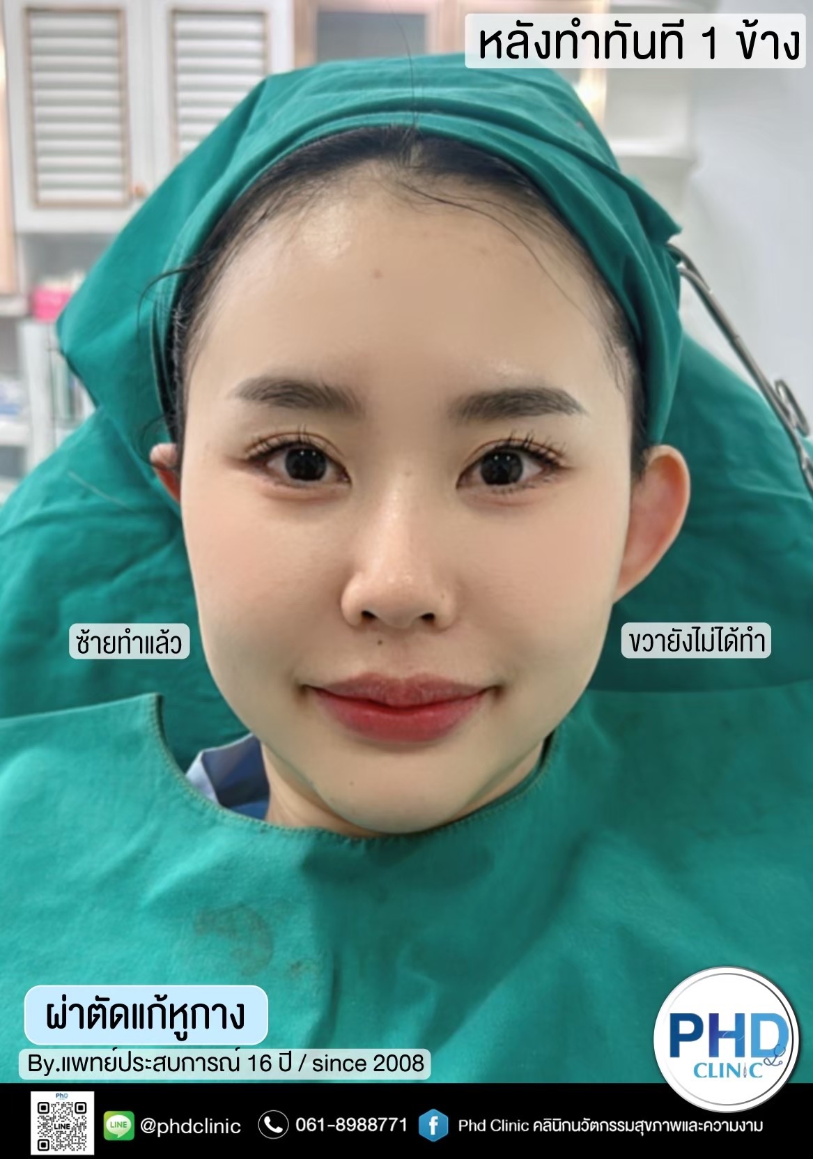 ผ่าตัดแก้หูกางพัทยา