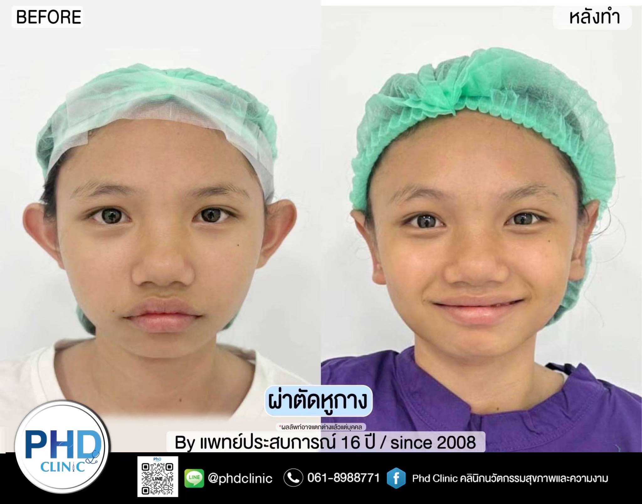 ผ่าตัดแก้หูกางพัทยา