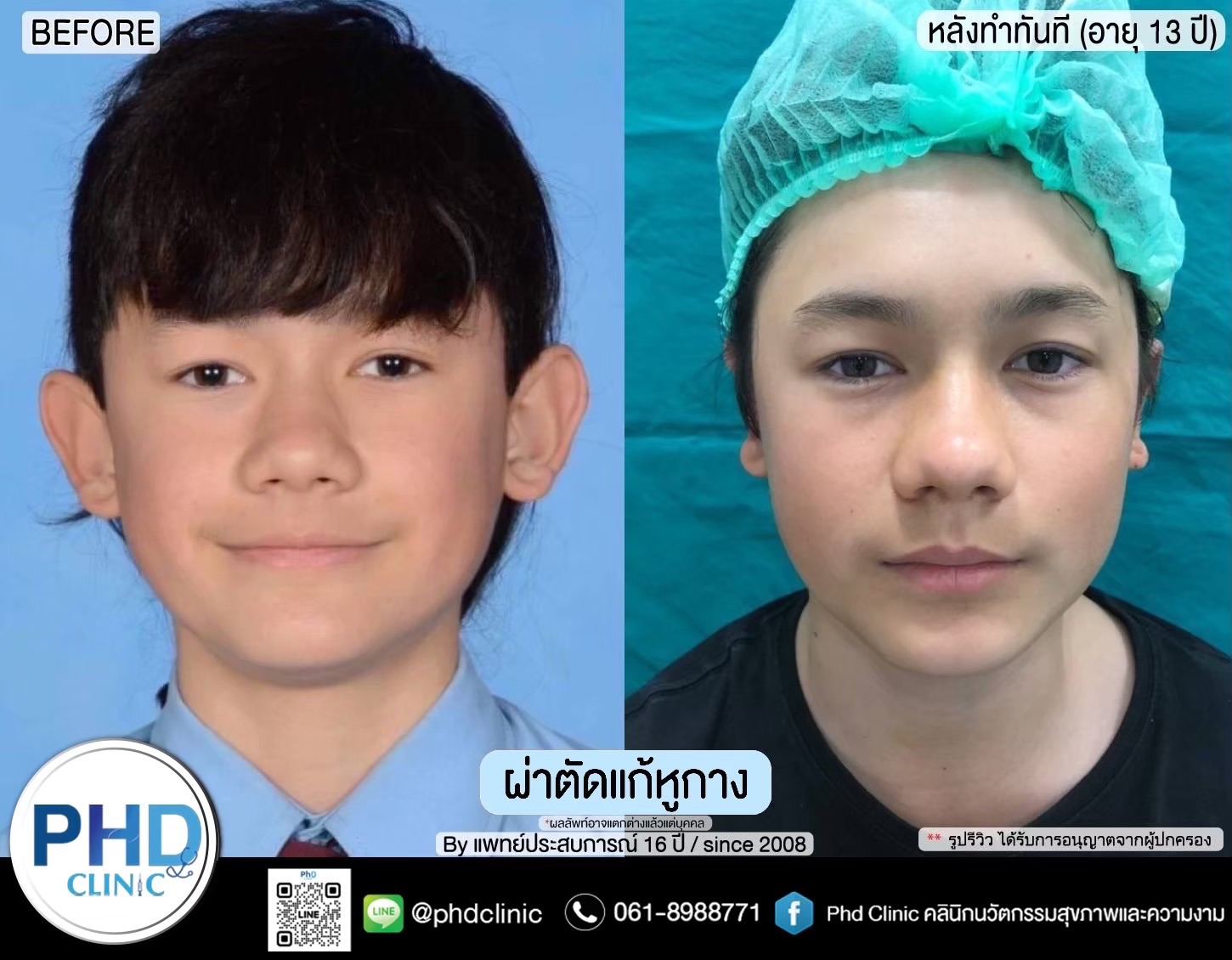 ผ่าตัดแก้หูกางพัทยา
