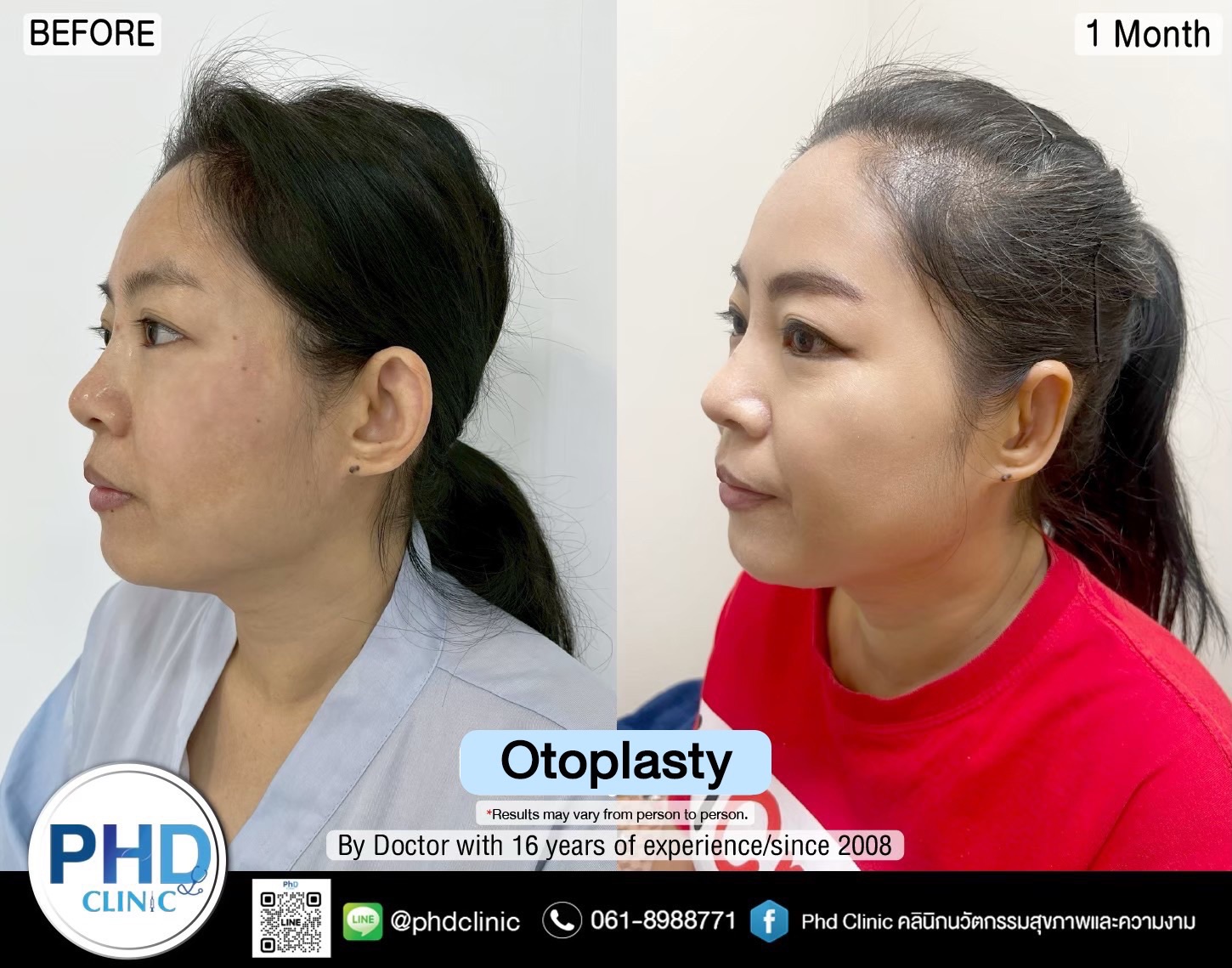 Otoplasty pattaya
