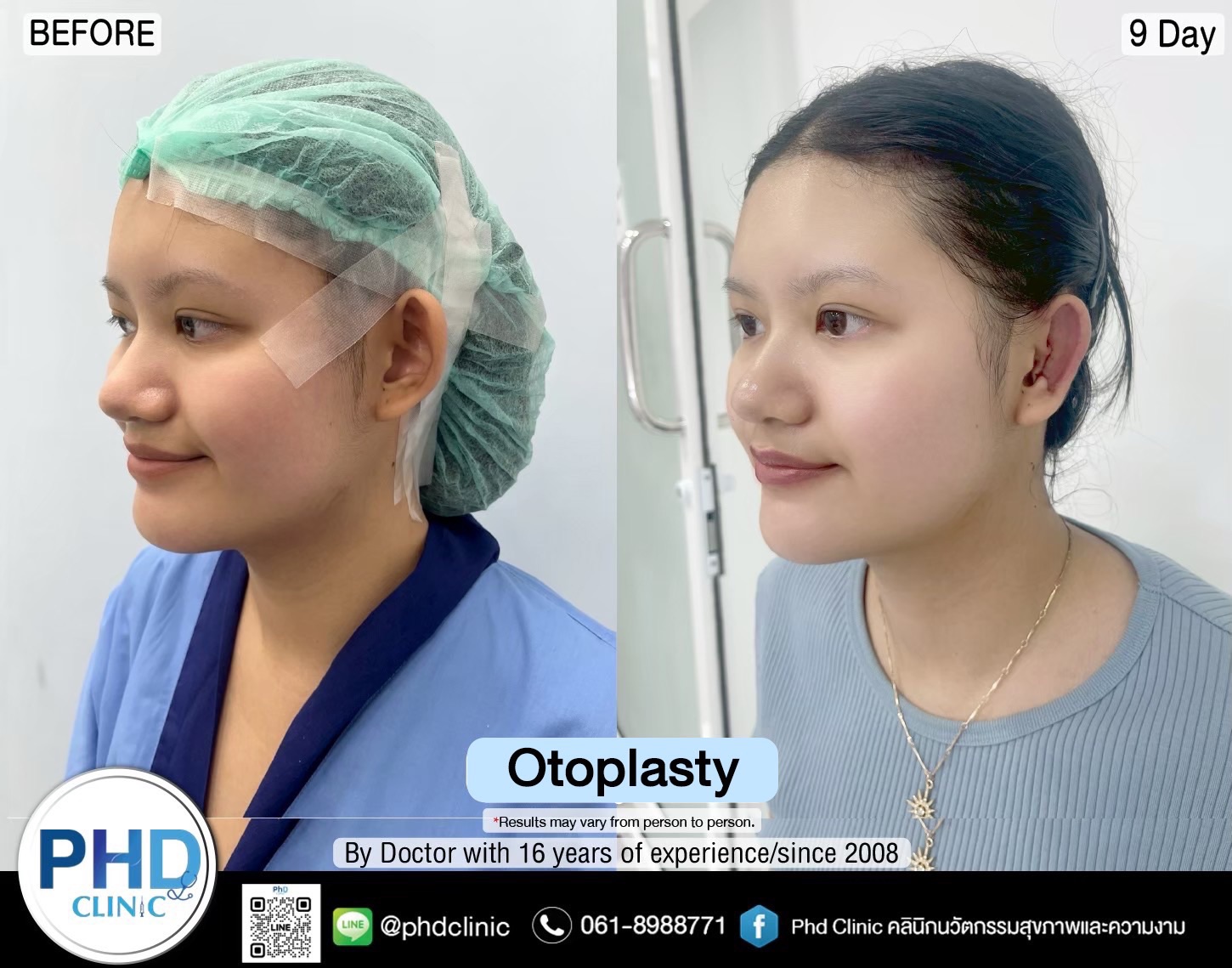 Otoplasty pattaya