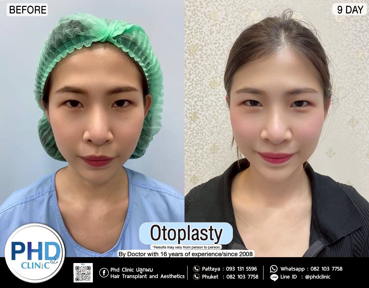 Otoplasty pattaya