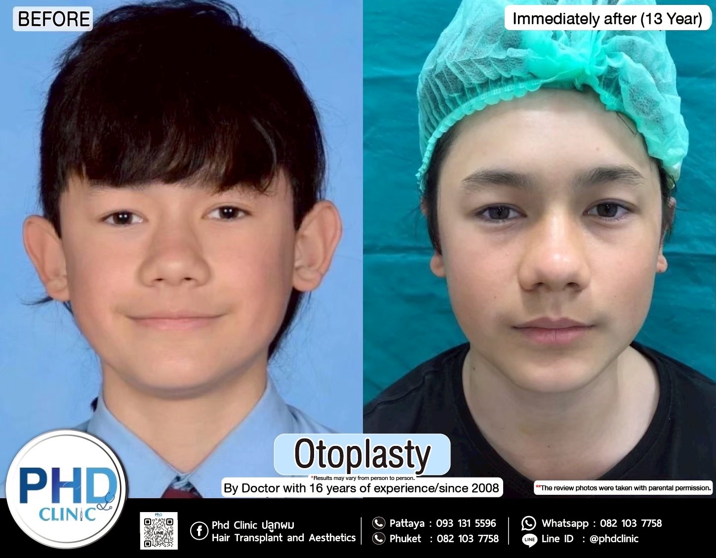 Otoplasty pattaya