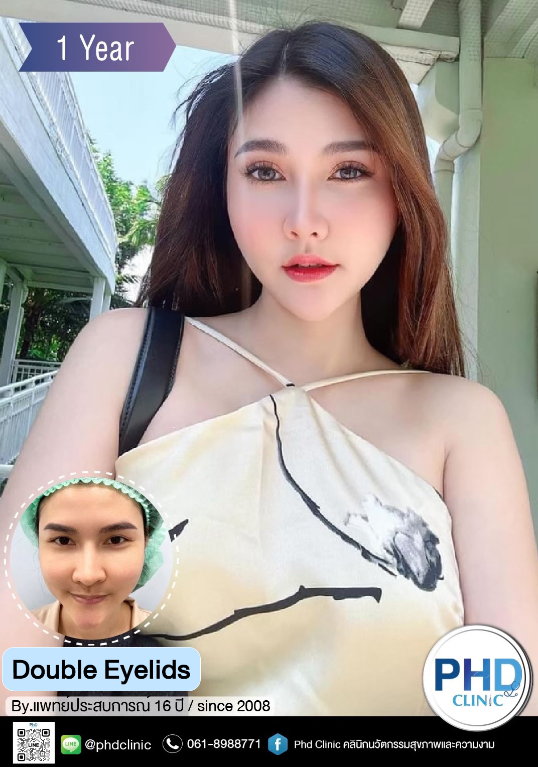 Double eyelid surgery
