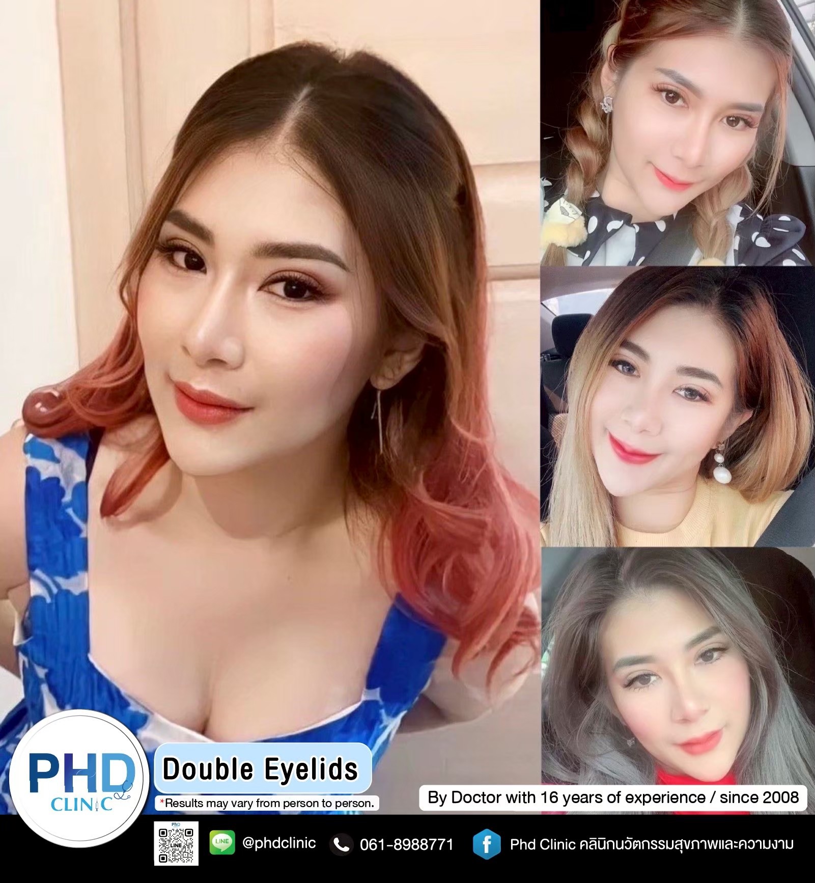 Double eyelid surgery