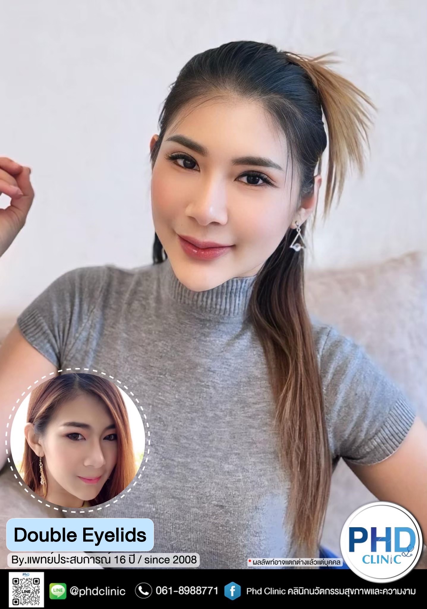 Double eyelid surgery