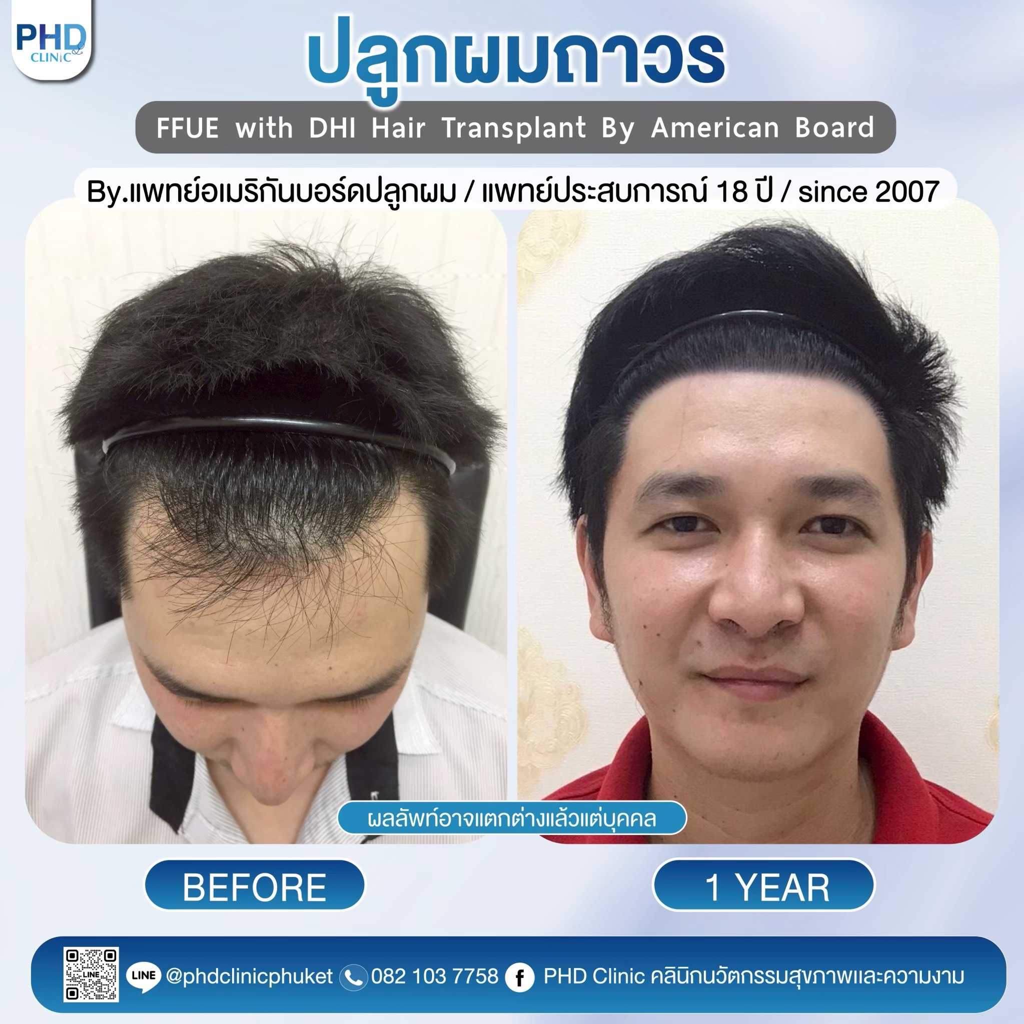 คลินิกปลูกผม