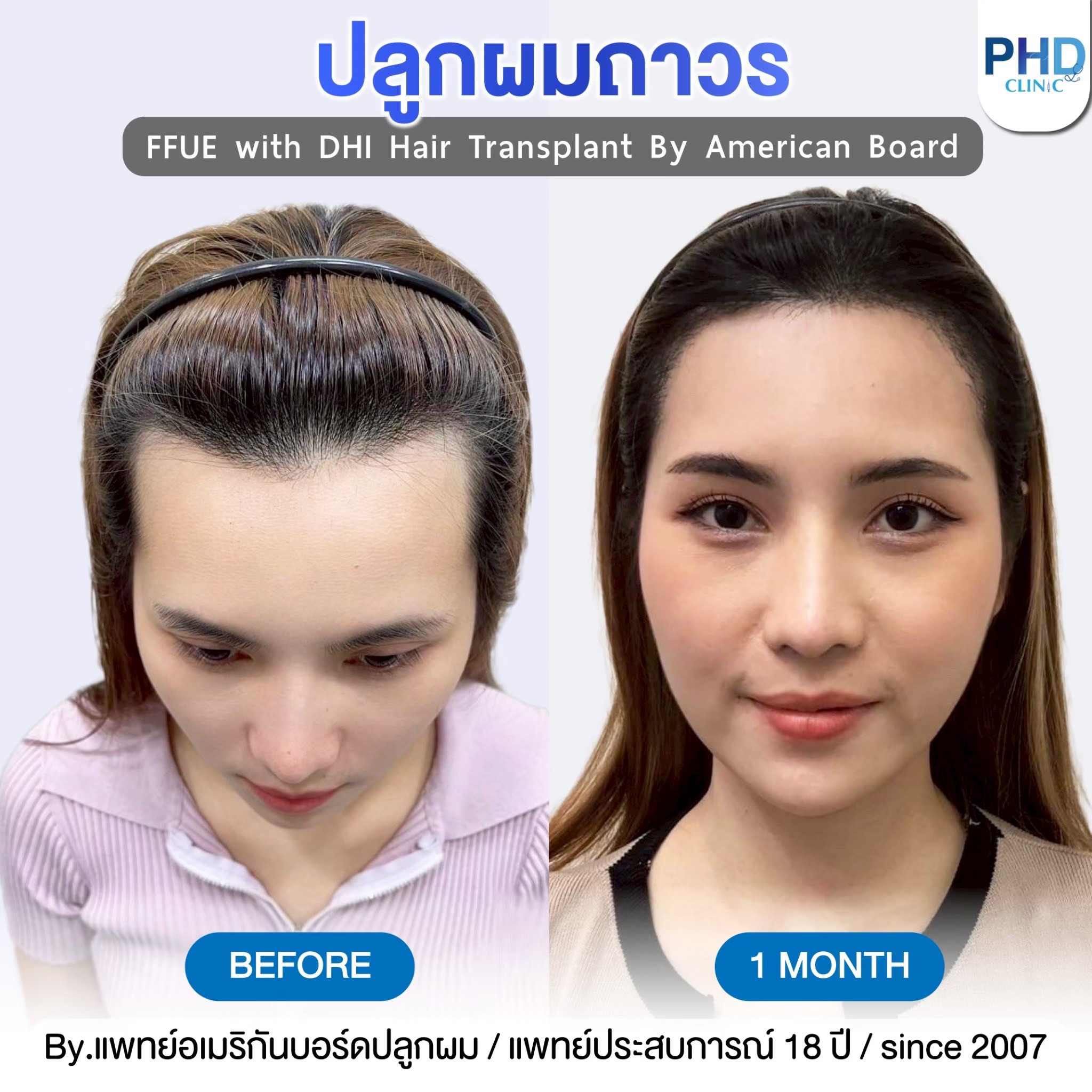 คลินิกปลูกผมพัทยา