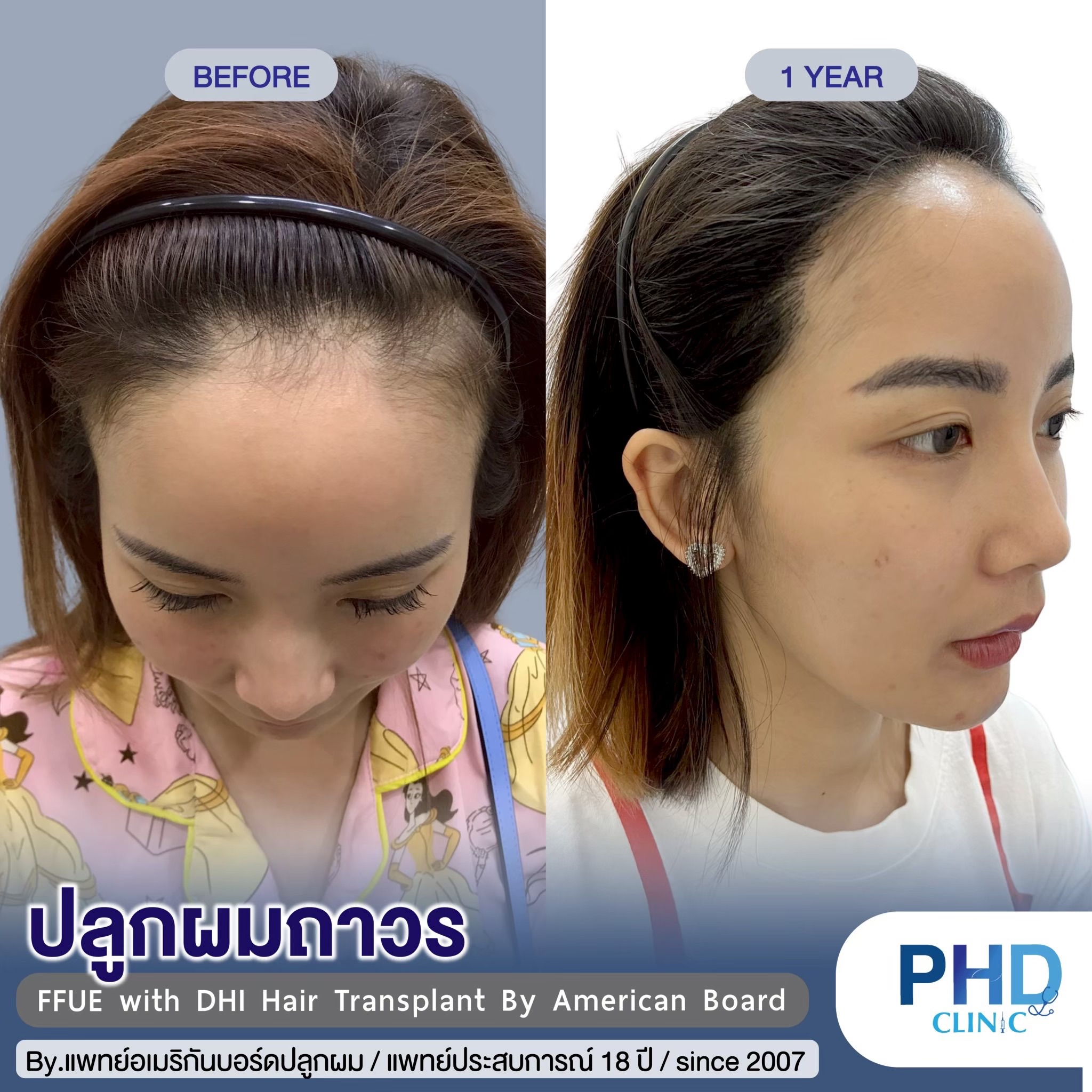 คลินิกปลูกผมพัทยา