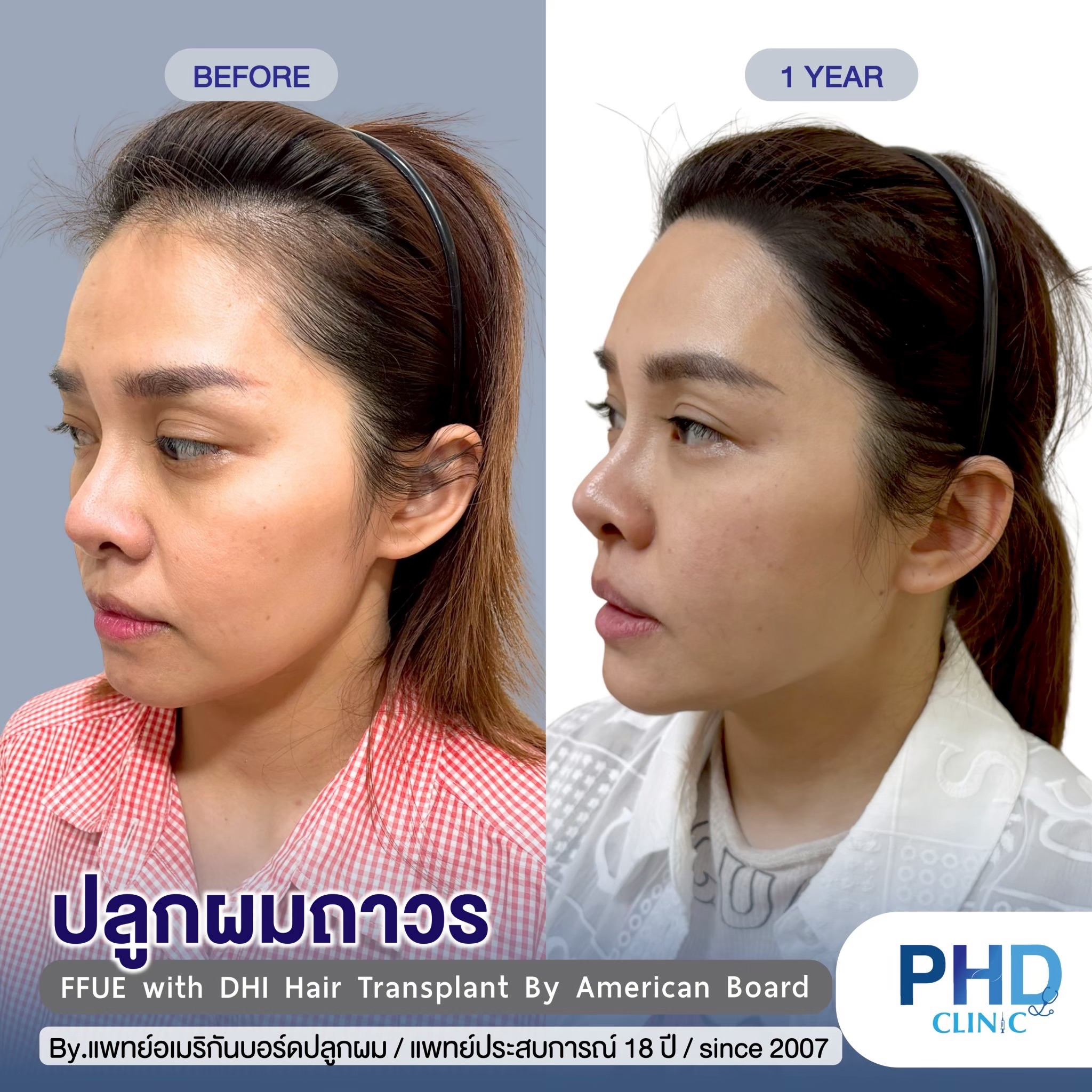 คลินิกปลูกผมพัทยา