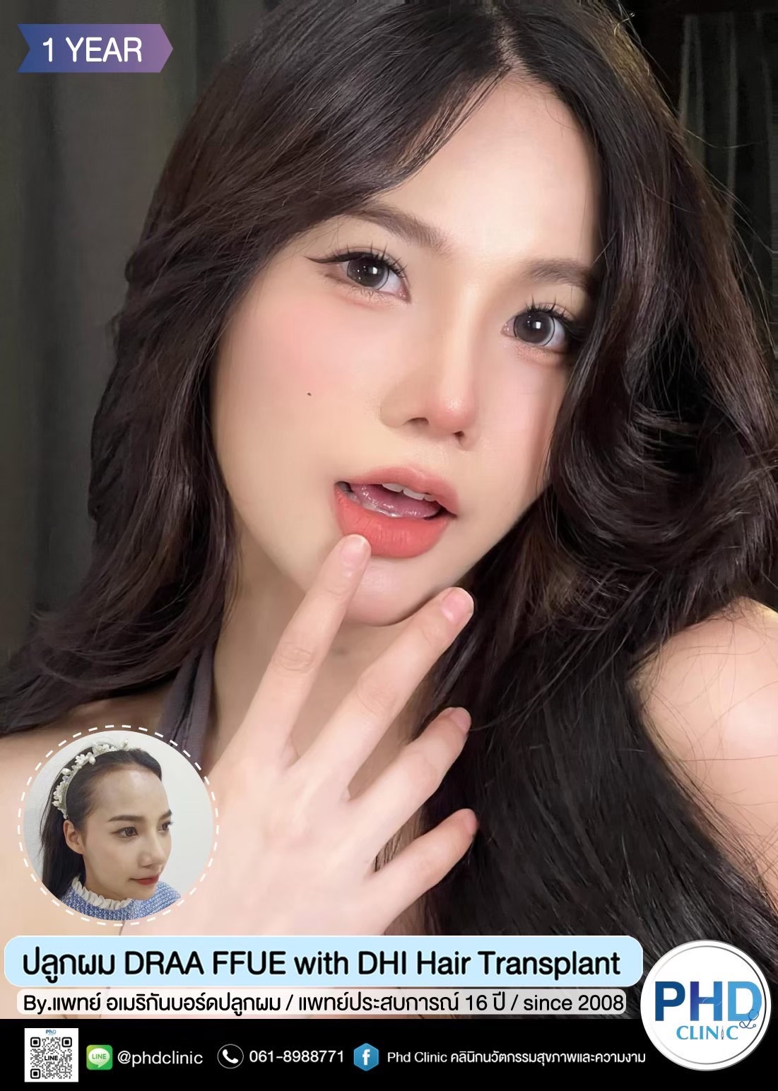 คลินิกปลูกผมภูเก็ต
