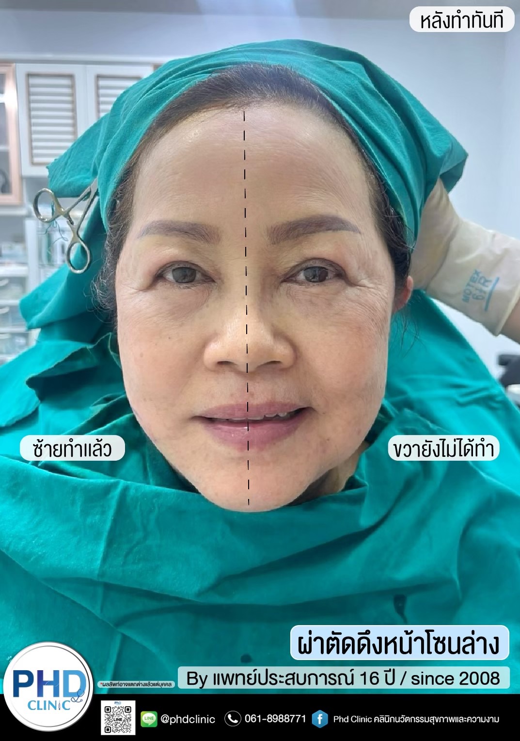 ผ่าตัดดึงหน้าภูเก็ต