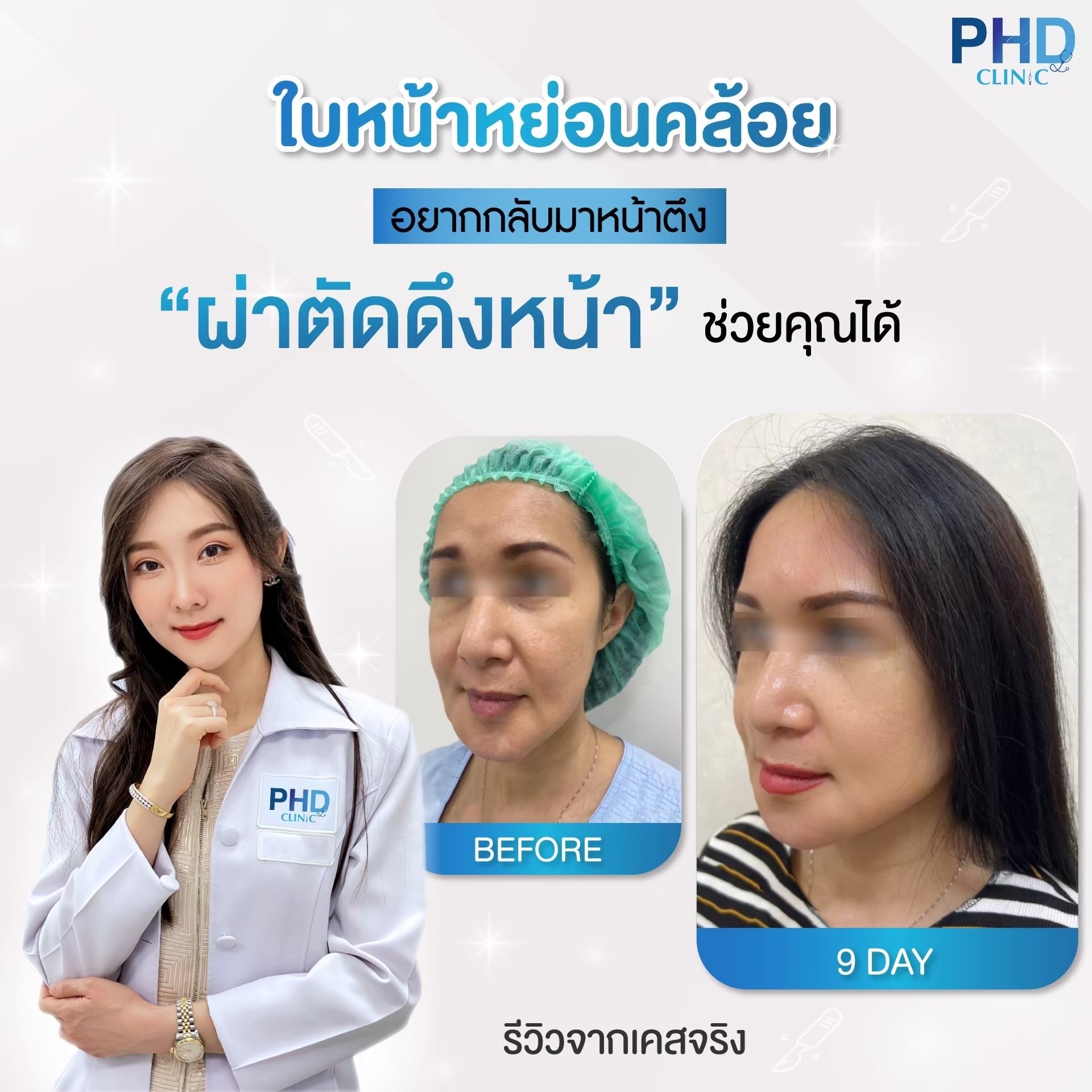 ผ่าตัดดึงหน้าภูเก็ต