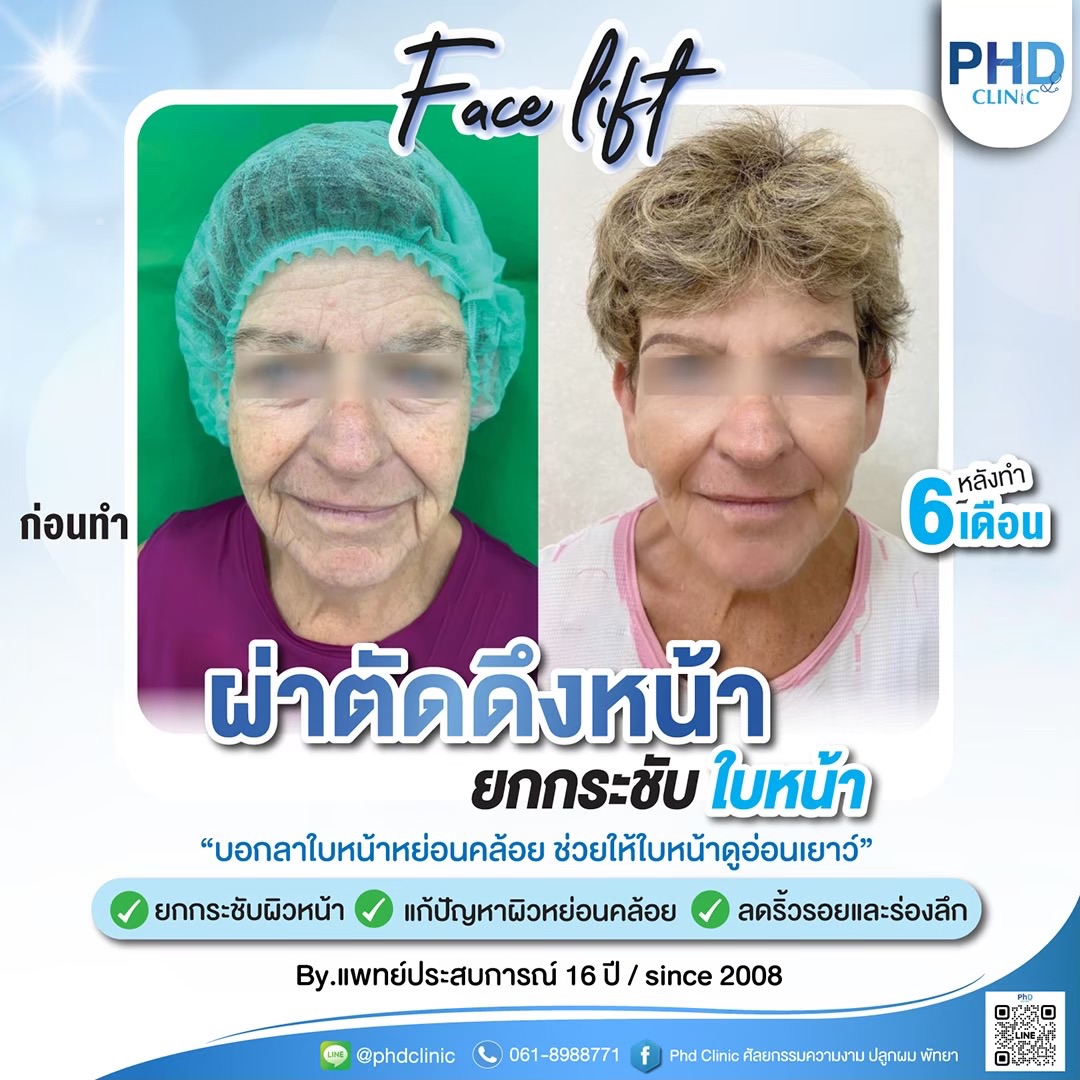 ผ่าตัดดึงหน้าภูเก็ต