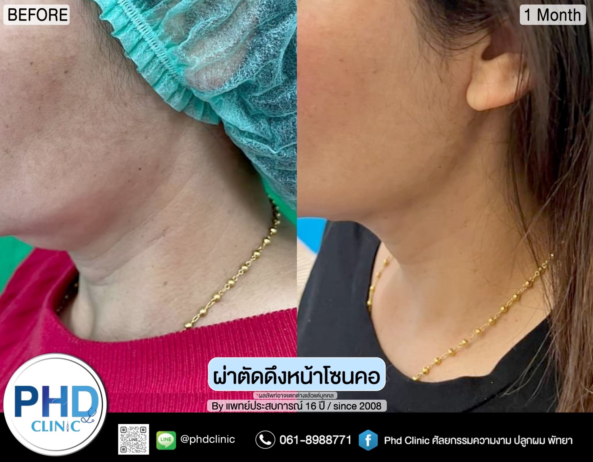 ผ่าตัดดึงหน้าภูเก็ต