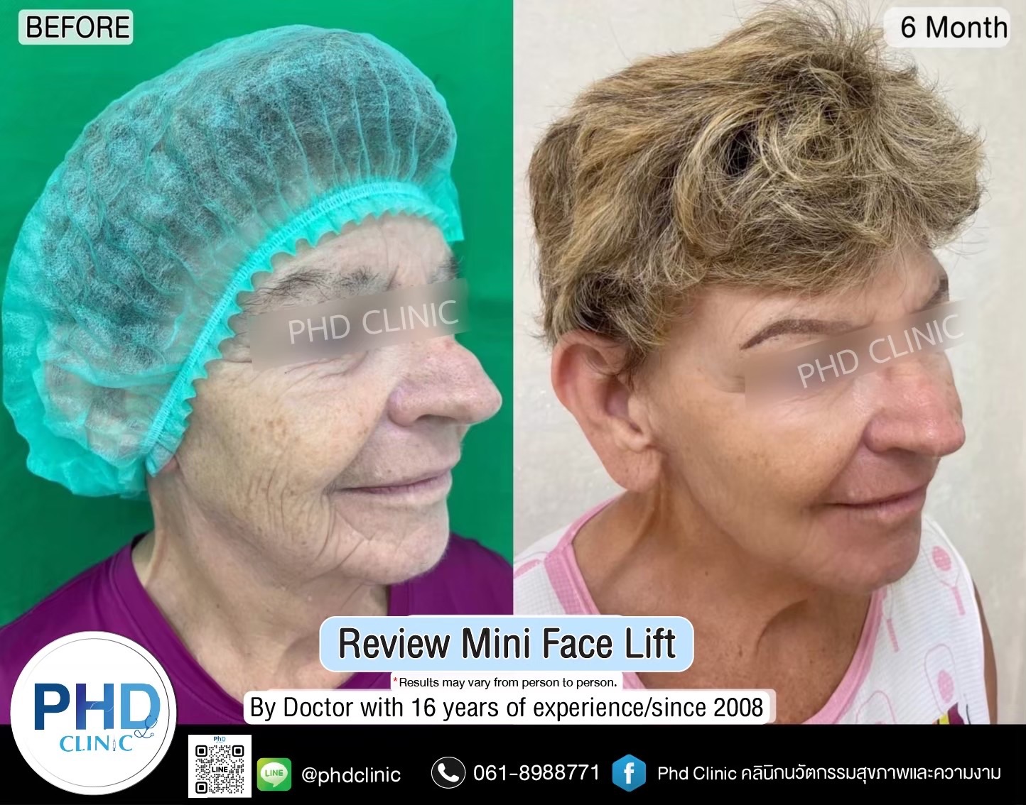 Where is the best facelift surgery in Pattaya?