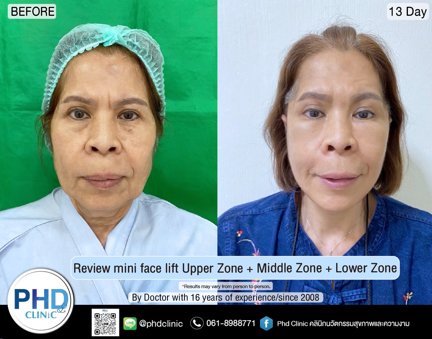 Where is the best facelift surgery in Pattaya?