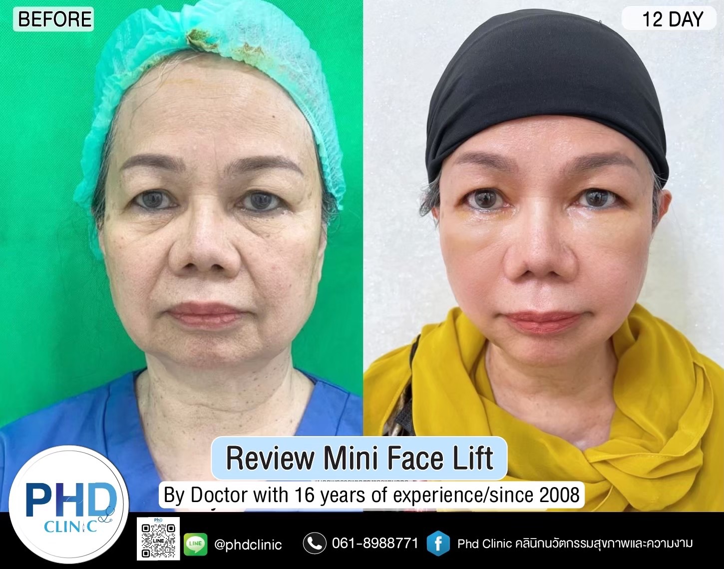 Where is the best facelift surgery in Pattaya?