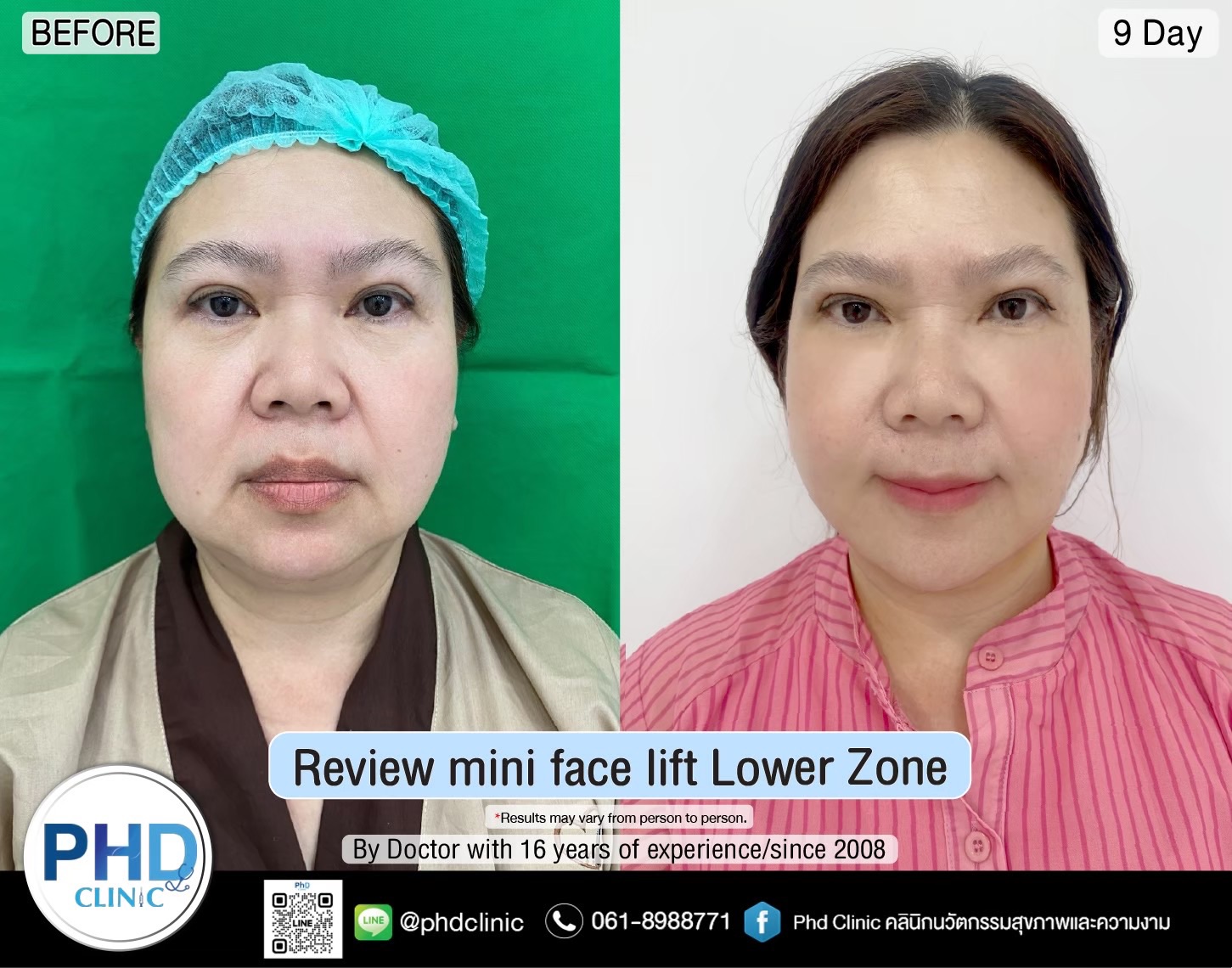 Where is the best facelift surgery in Pattaya?