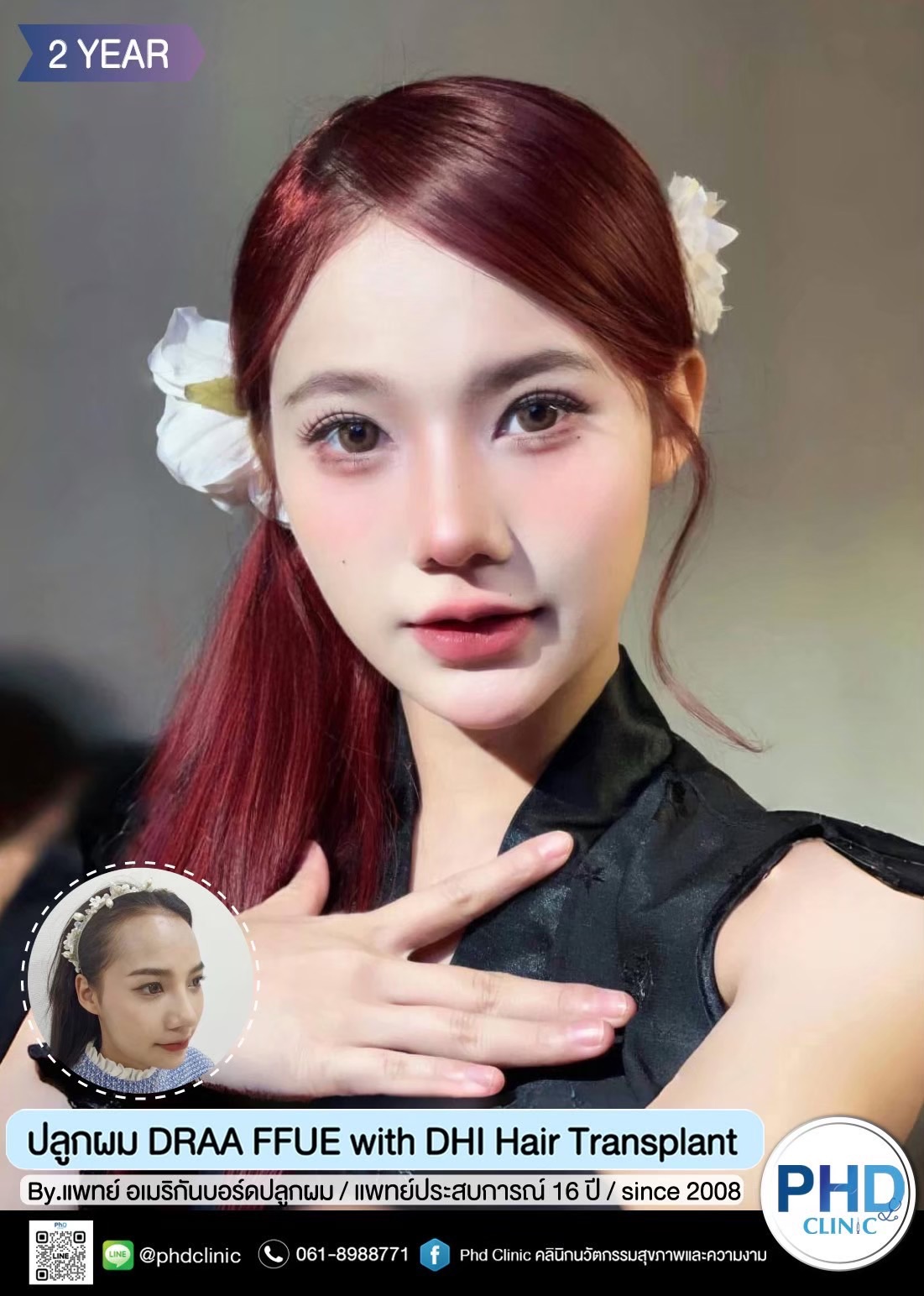 การปลูกไรผม