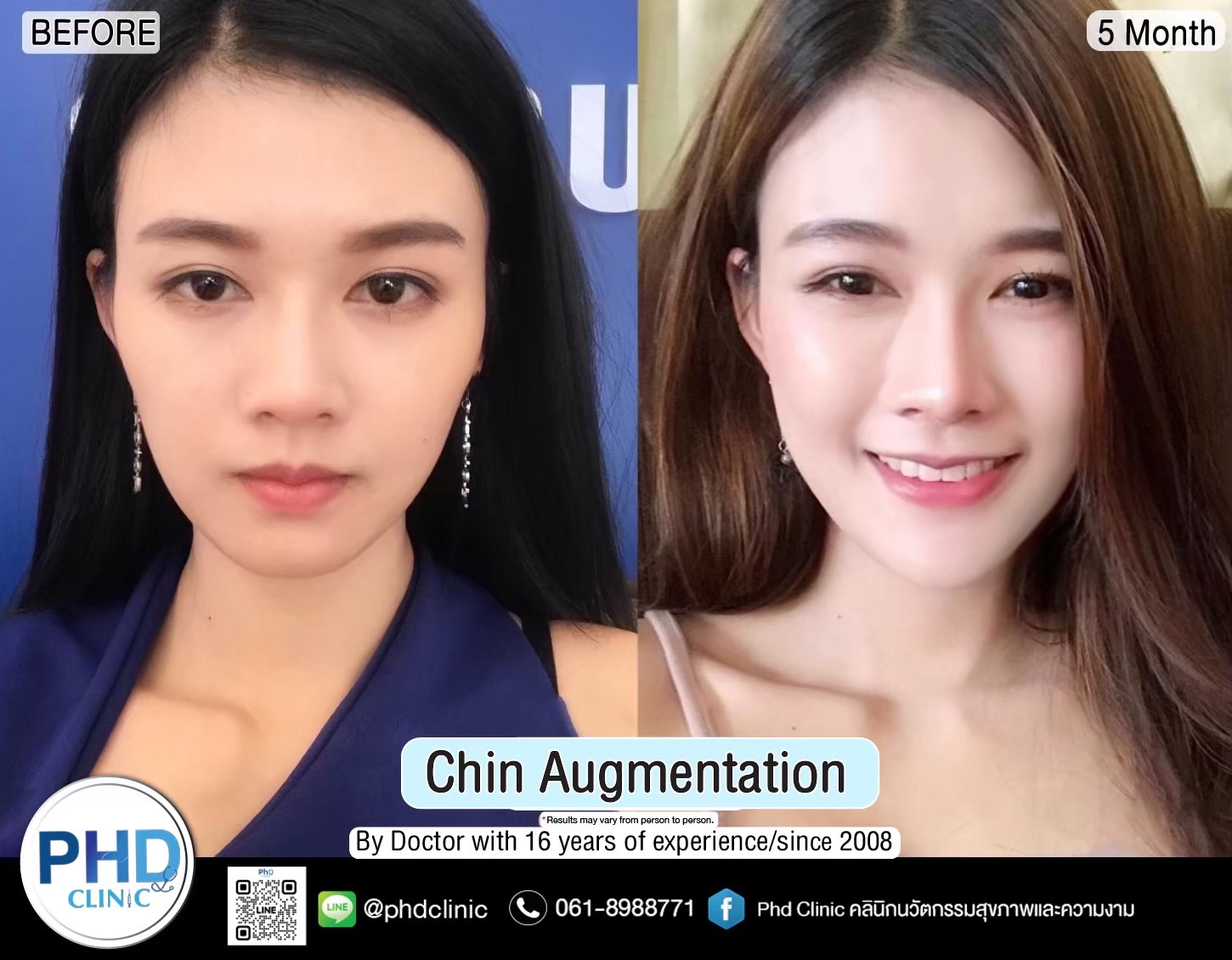 Where is the best Chin augmentation in Pattaya