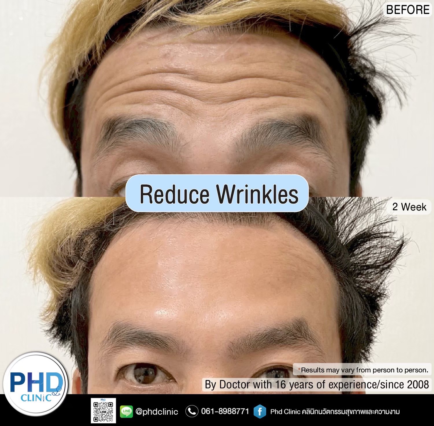 Reduce wrinkles