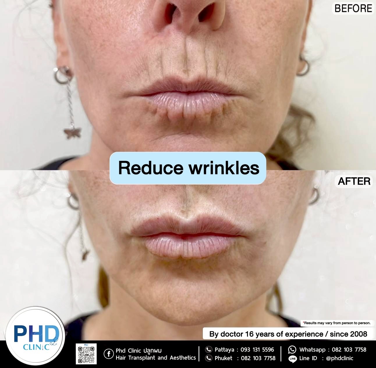 Reduce wrinkles