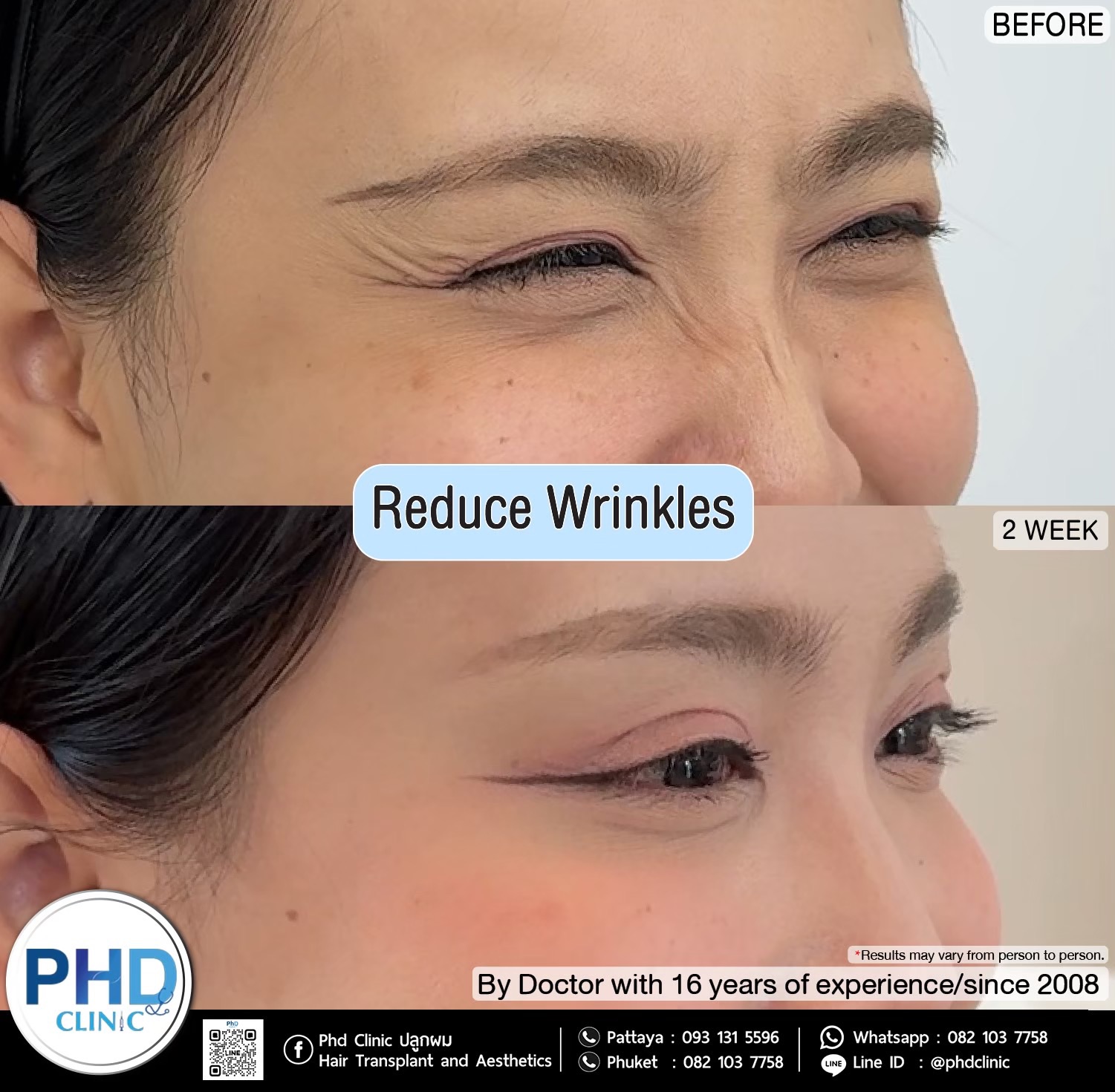 Reduce wrinkles