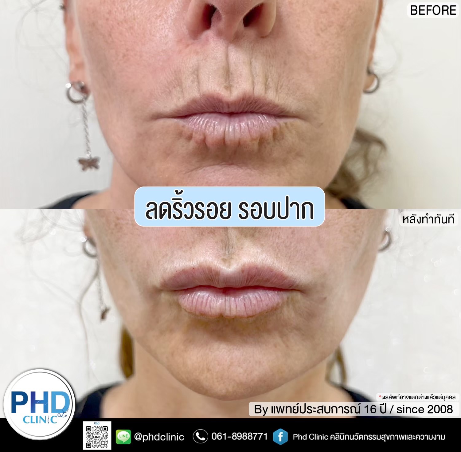 ลดริ้วรอยหน้าผาก