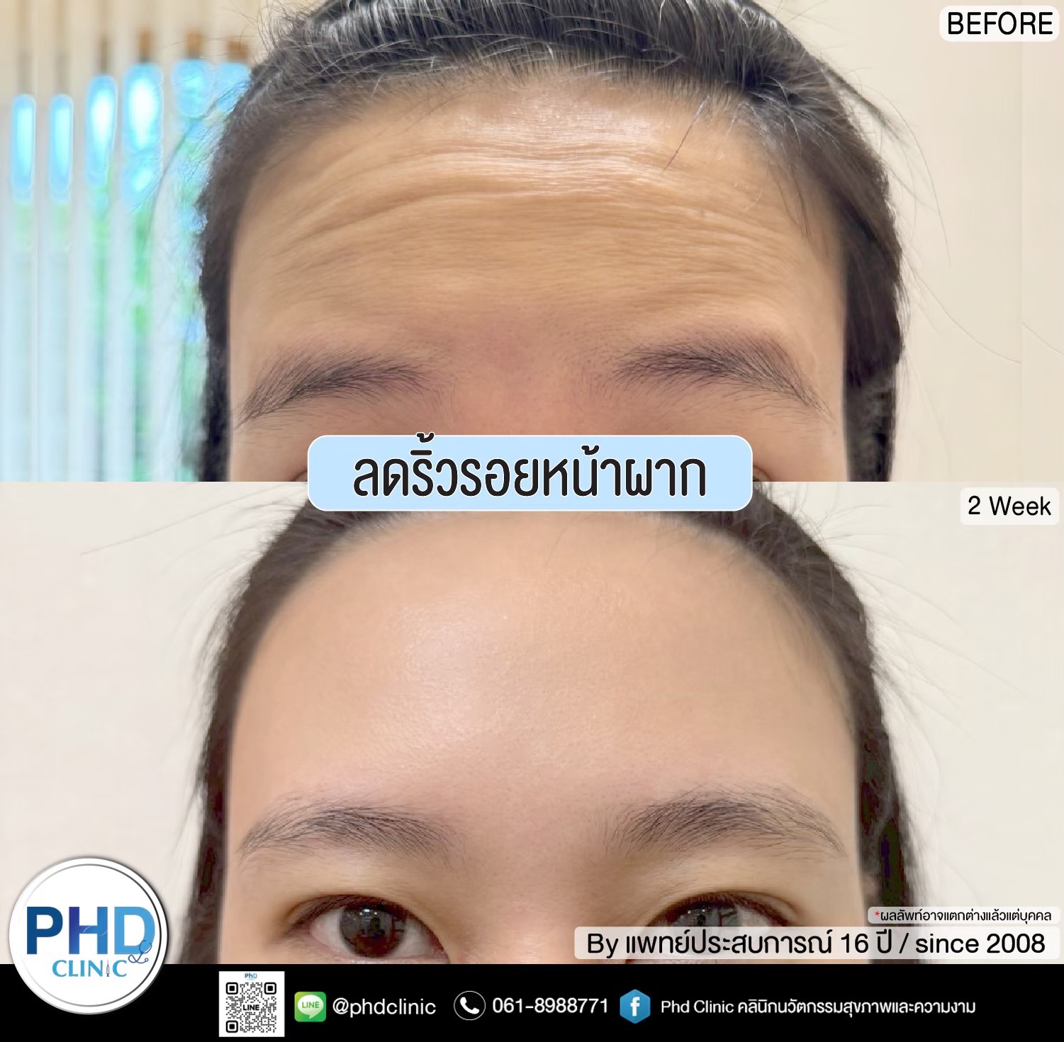 ลดริ้วรอยหน้าผาก