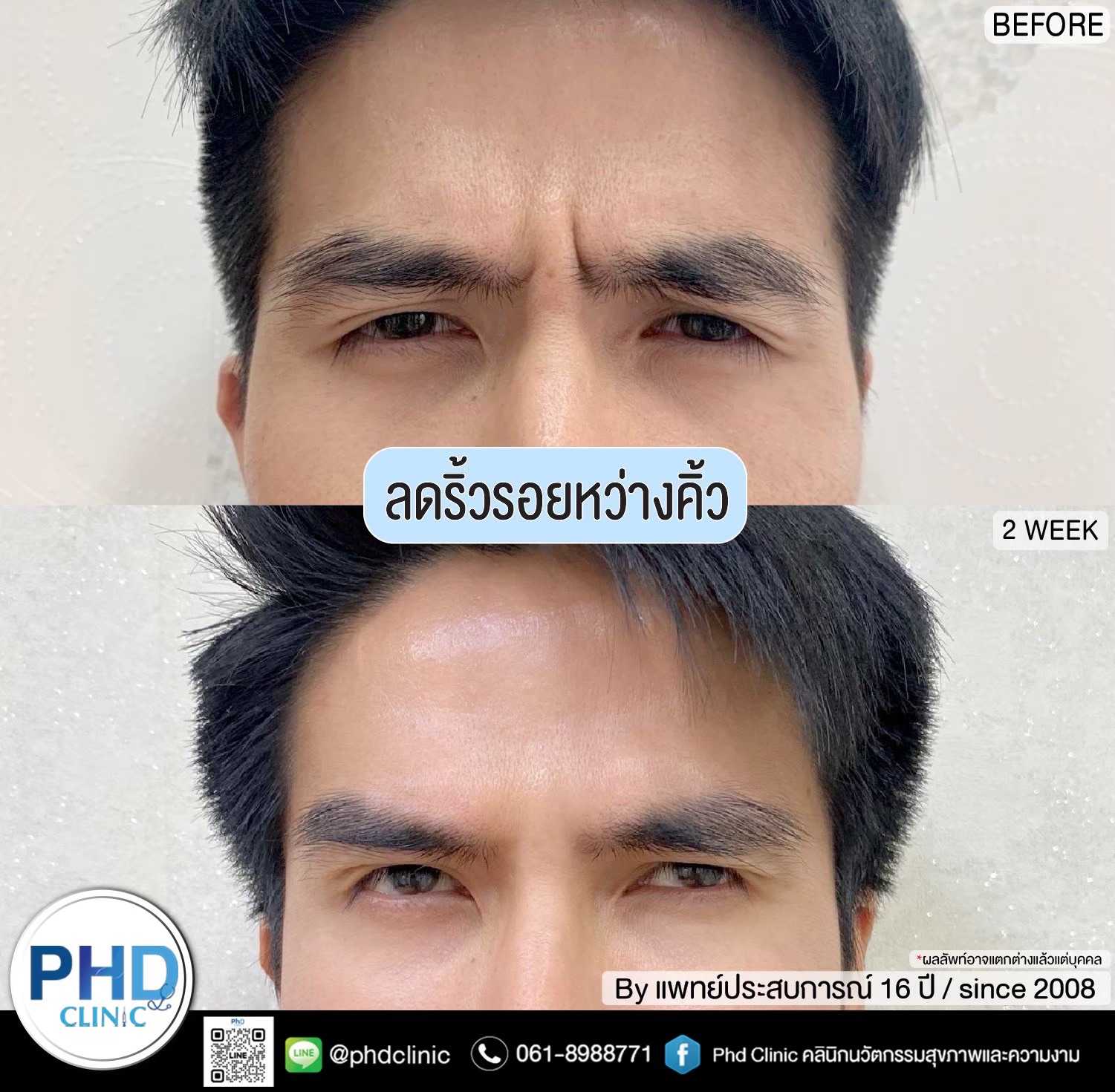 ลดริ้วรอยหน้าผาก