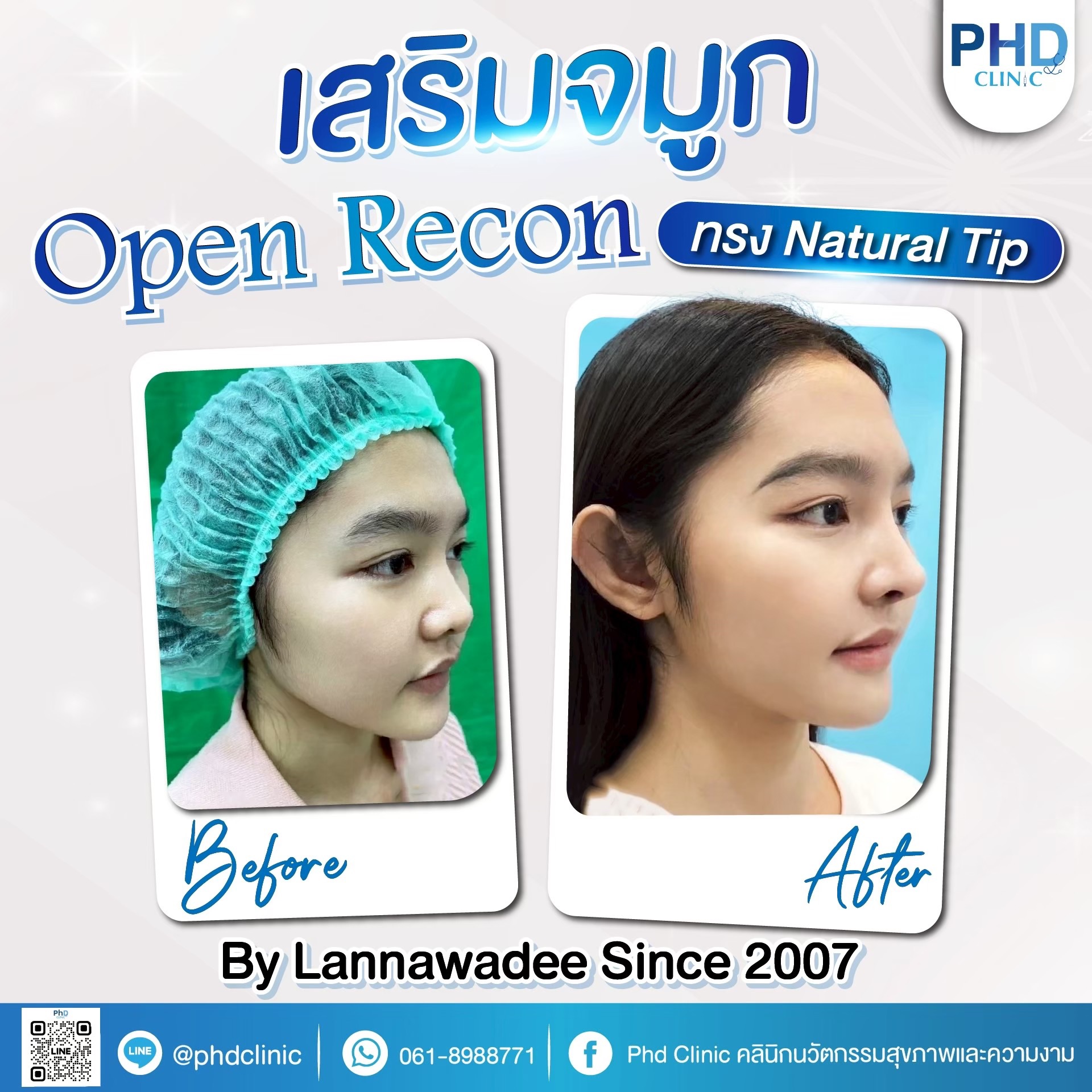 เสริมจมูก