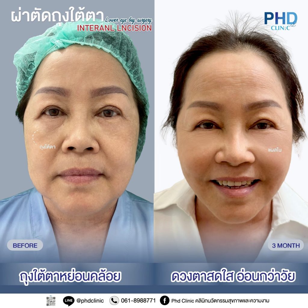 ผ่าตัดถุงใต้ตา