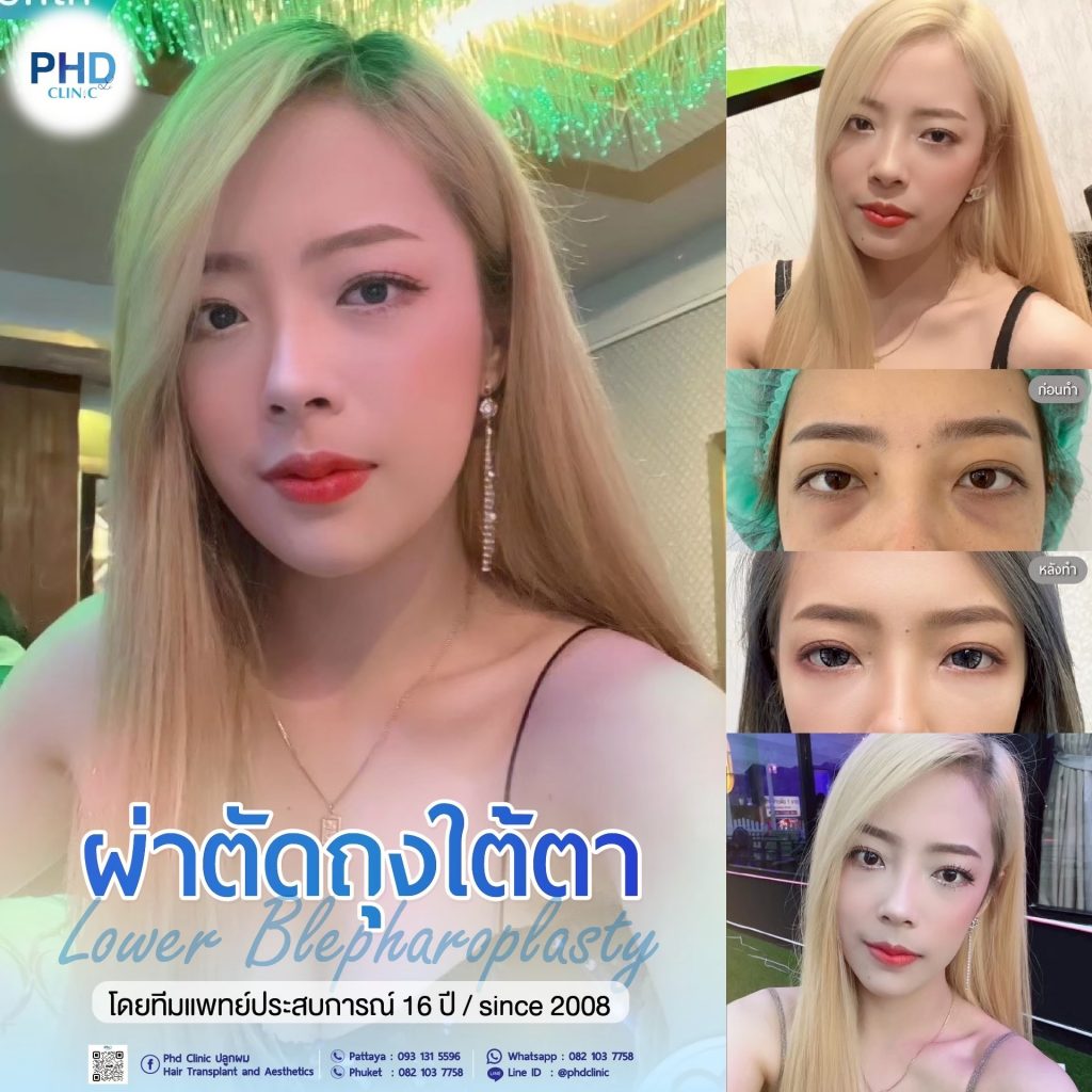 ผ่าตัดถุงใต้ตา
