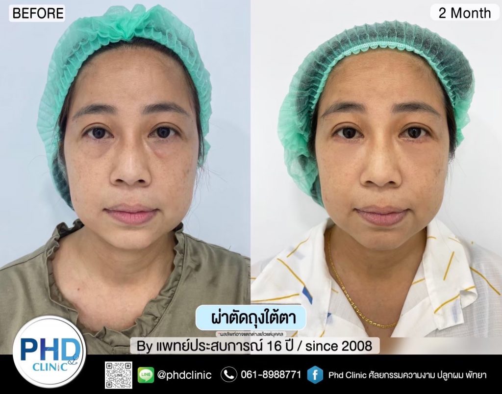 ผ่าตัดถุงใต้ตา