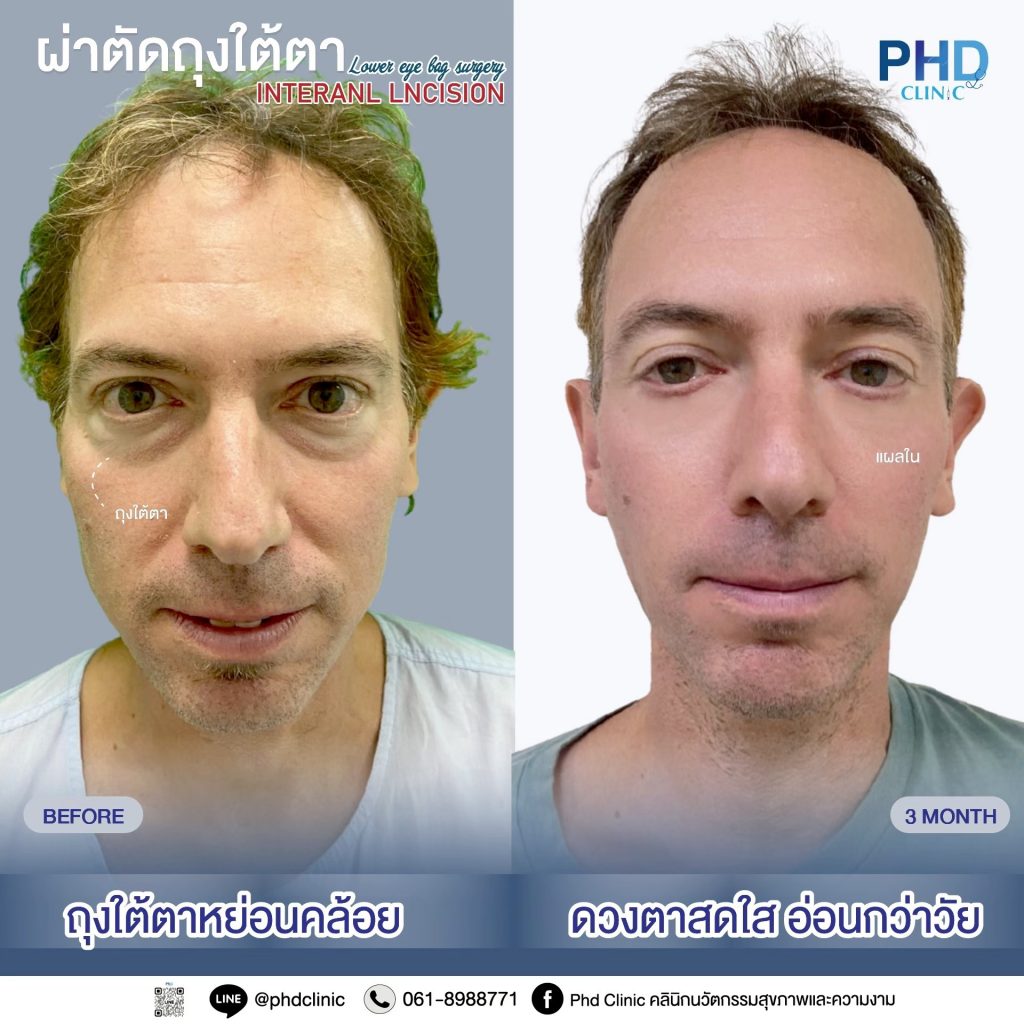 ผ่าตัดถุงใต้ตา