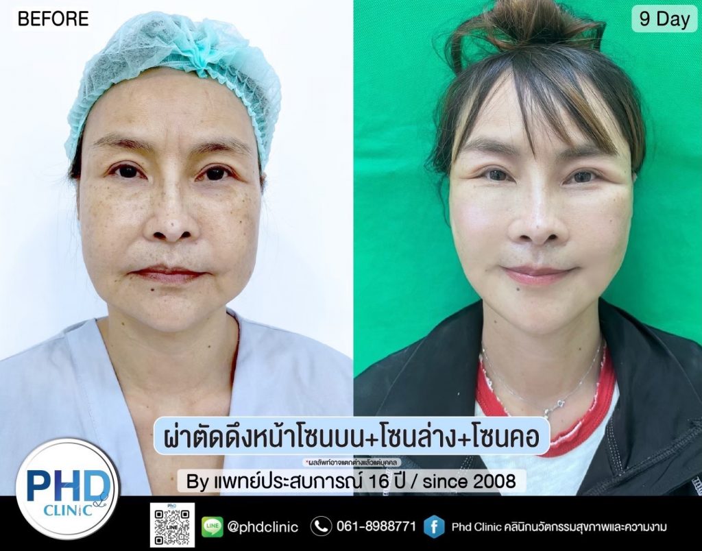 ผ่าตัดดึงหน้ากรุงเทพ