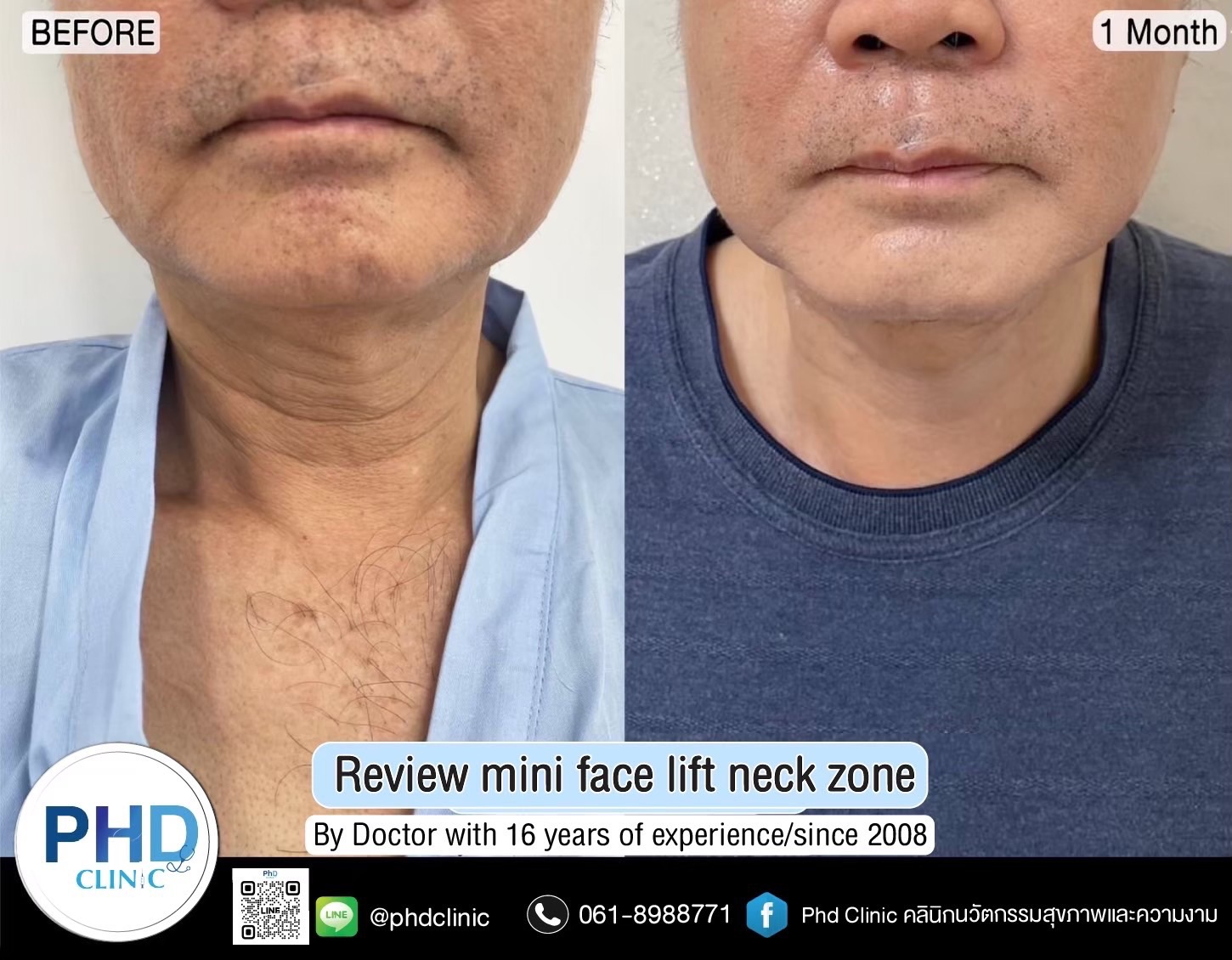 Facelift Bangkok